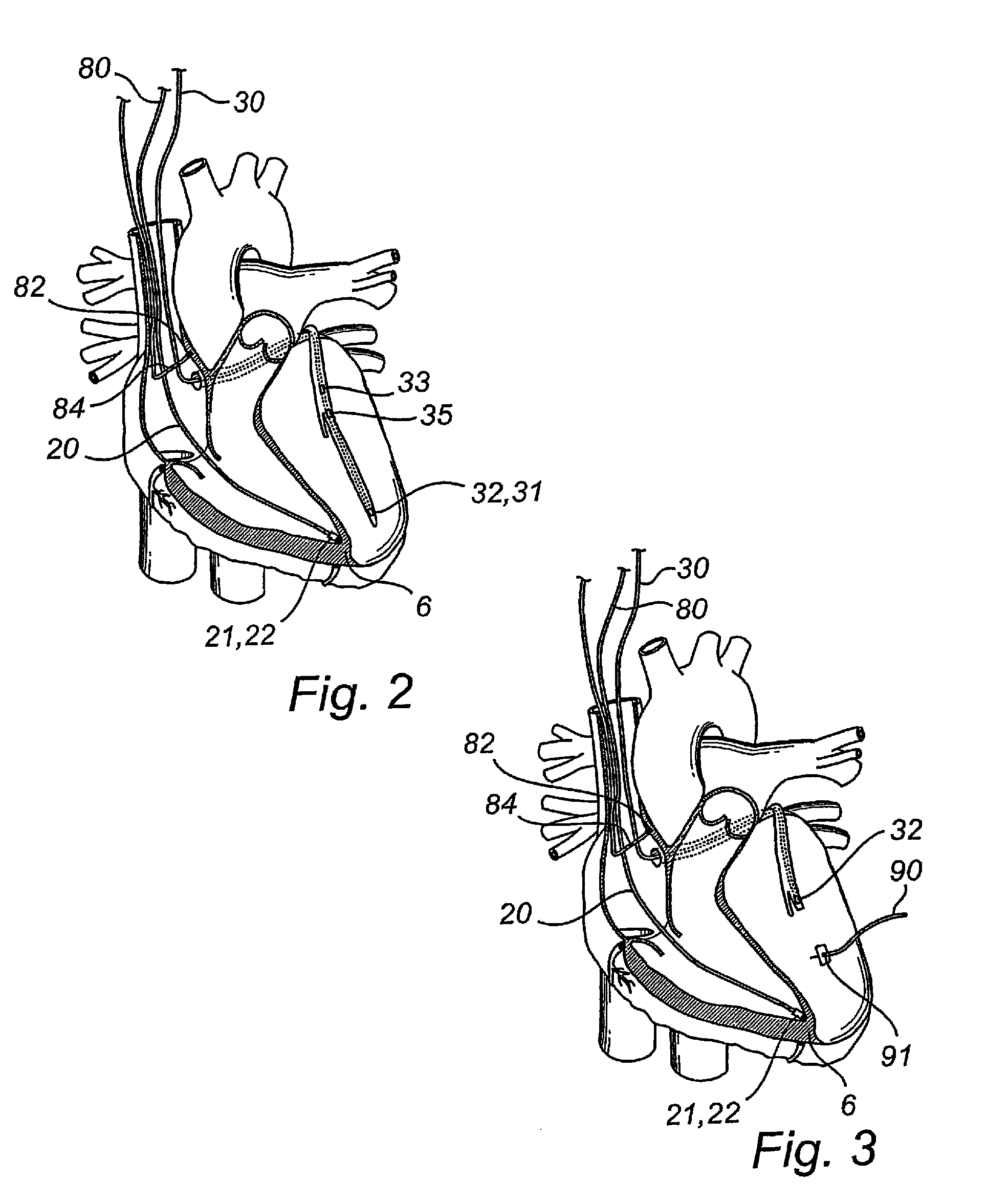 Implantable cardiac stimulator, system, device and method for monitoring cardiac synchrony