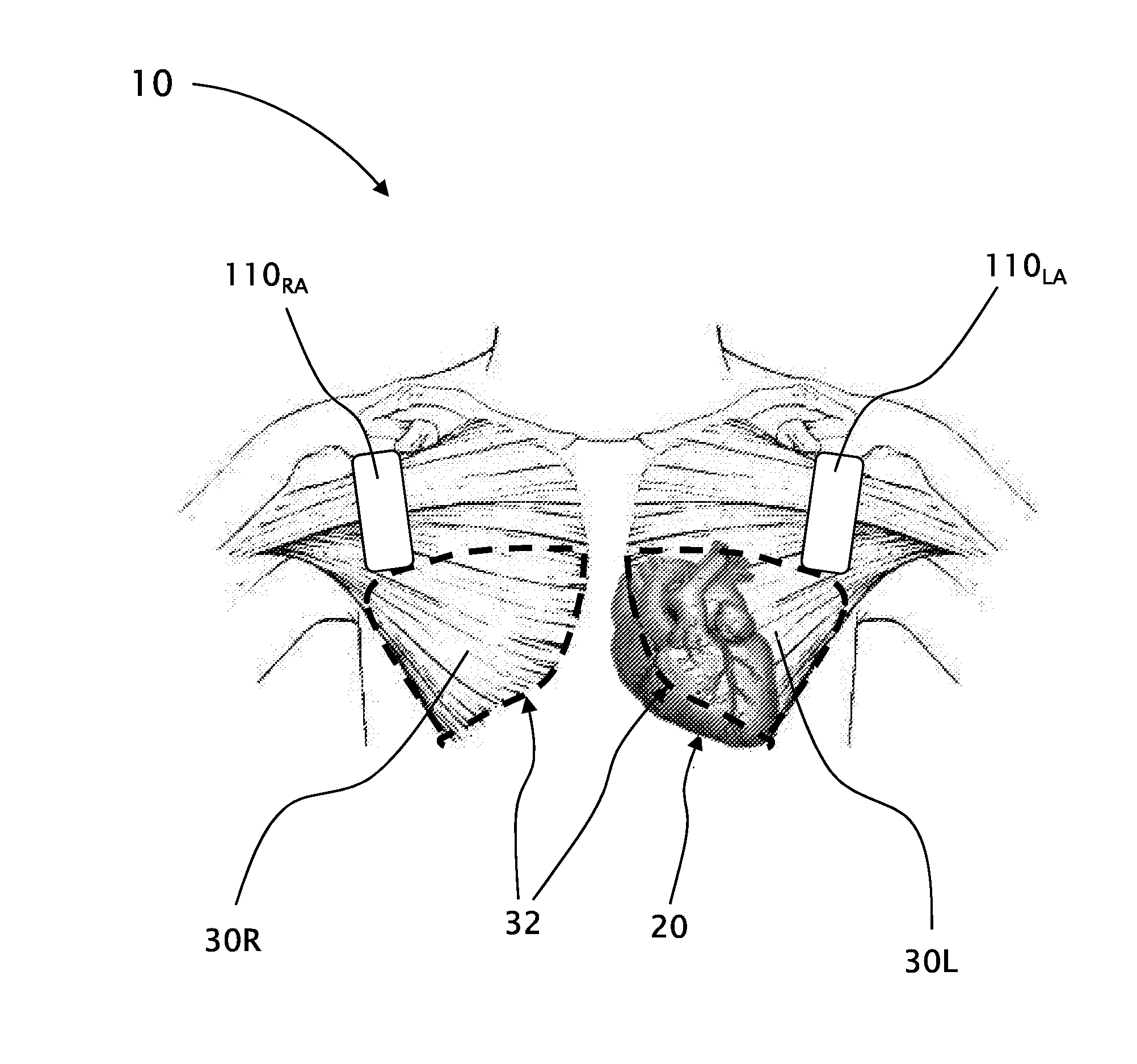 Devices and methods for obtaining workable ECG signals using dry knitted electrodes