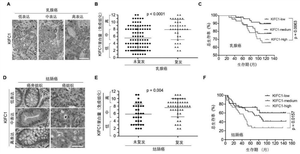 Marker KIFC1 for predicting drug resistance and recurrence of tumors and inhibitor thereof and use of marker KIFC1 and inhibitor thereof