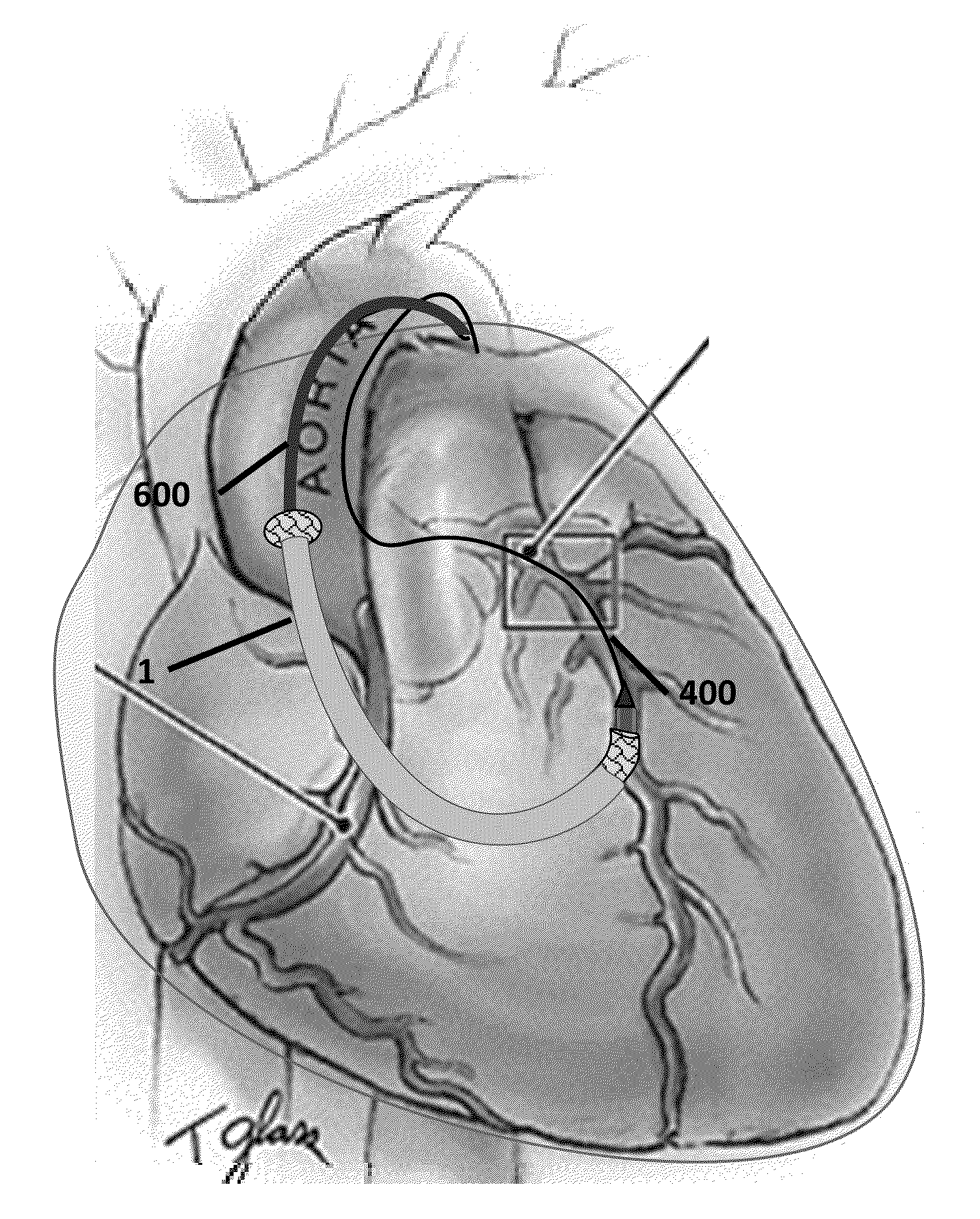 Methods and devices for minimally invasive transcatheter coronary artery bypass grafting