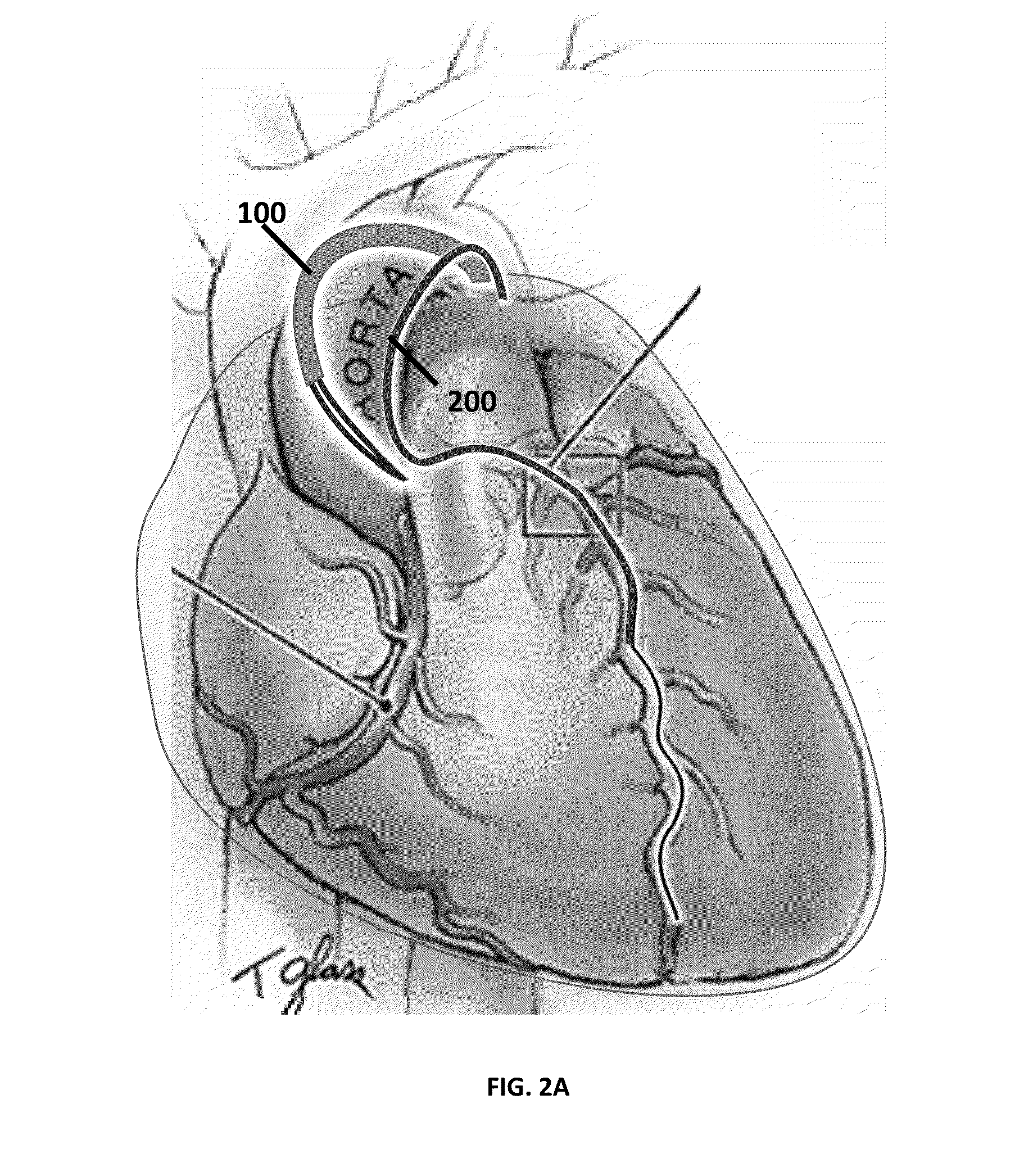 Methods and devices for minimally invasive transcatheter coronary artery bypass grafting