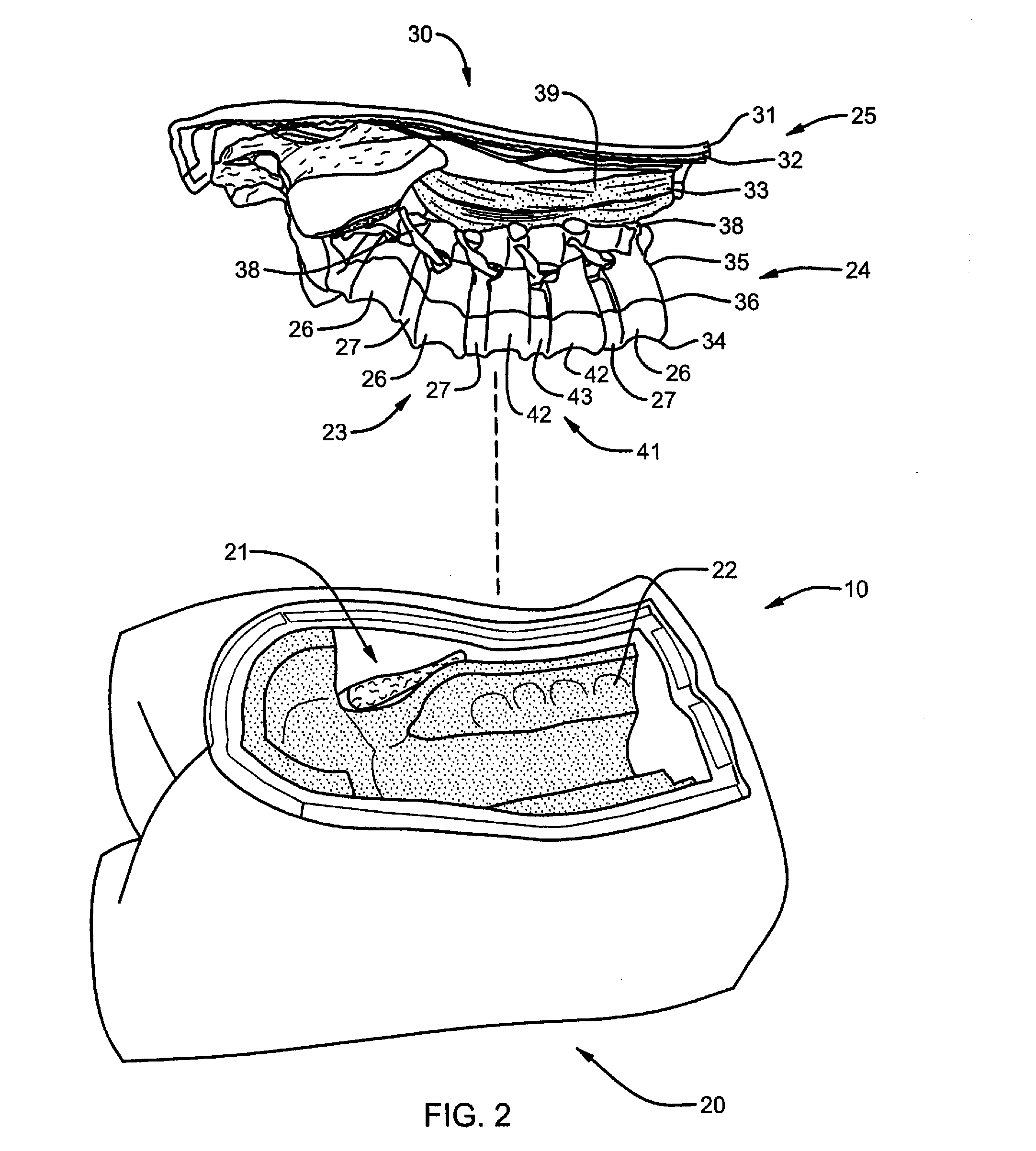 Surgical training model and method for use in facilitating training of a surgical procedure