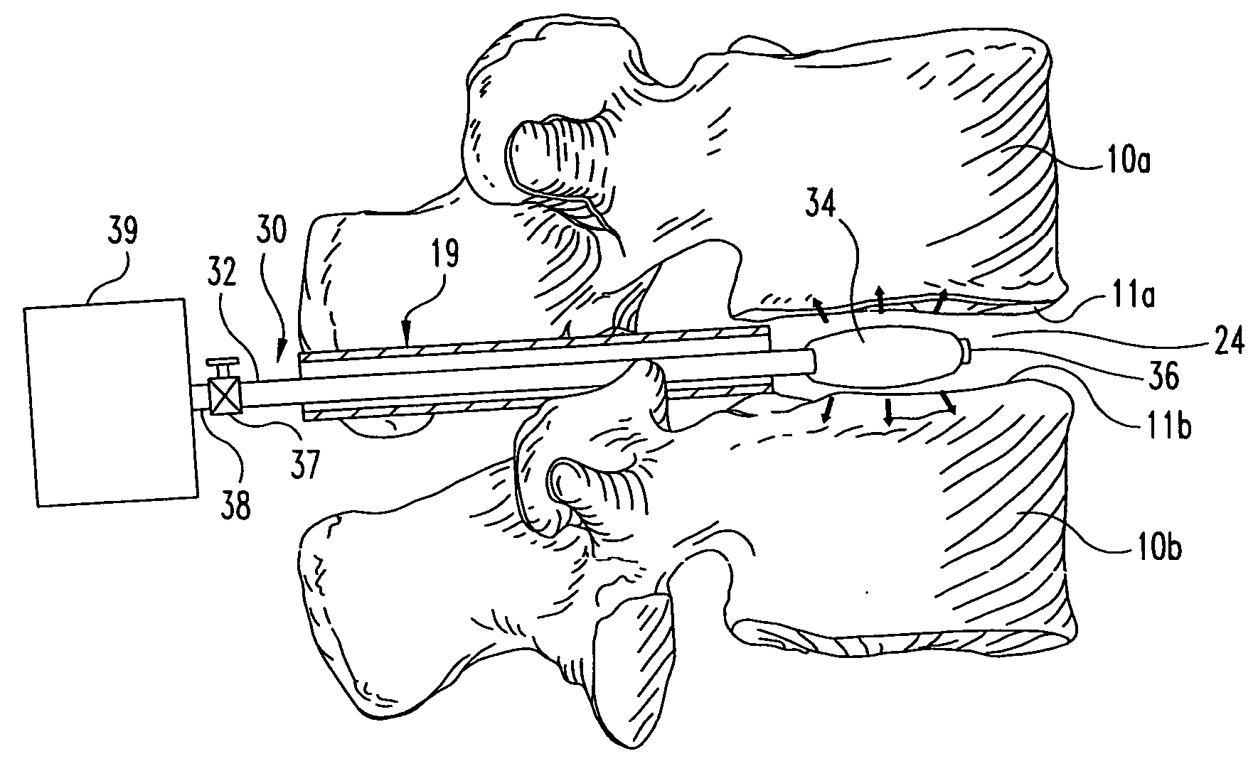 Methods and devices for interbody spinal stabilization