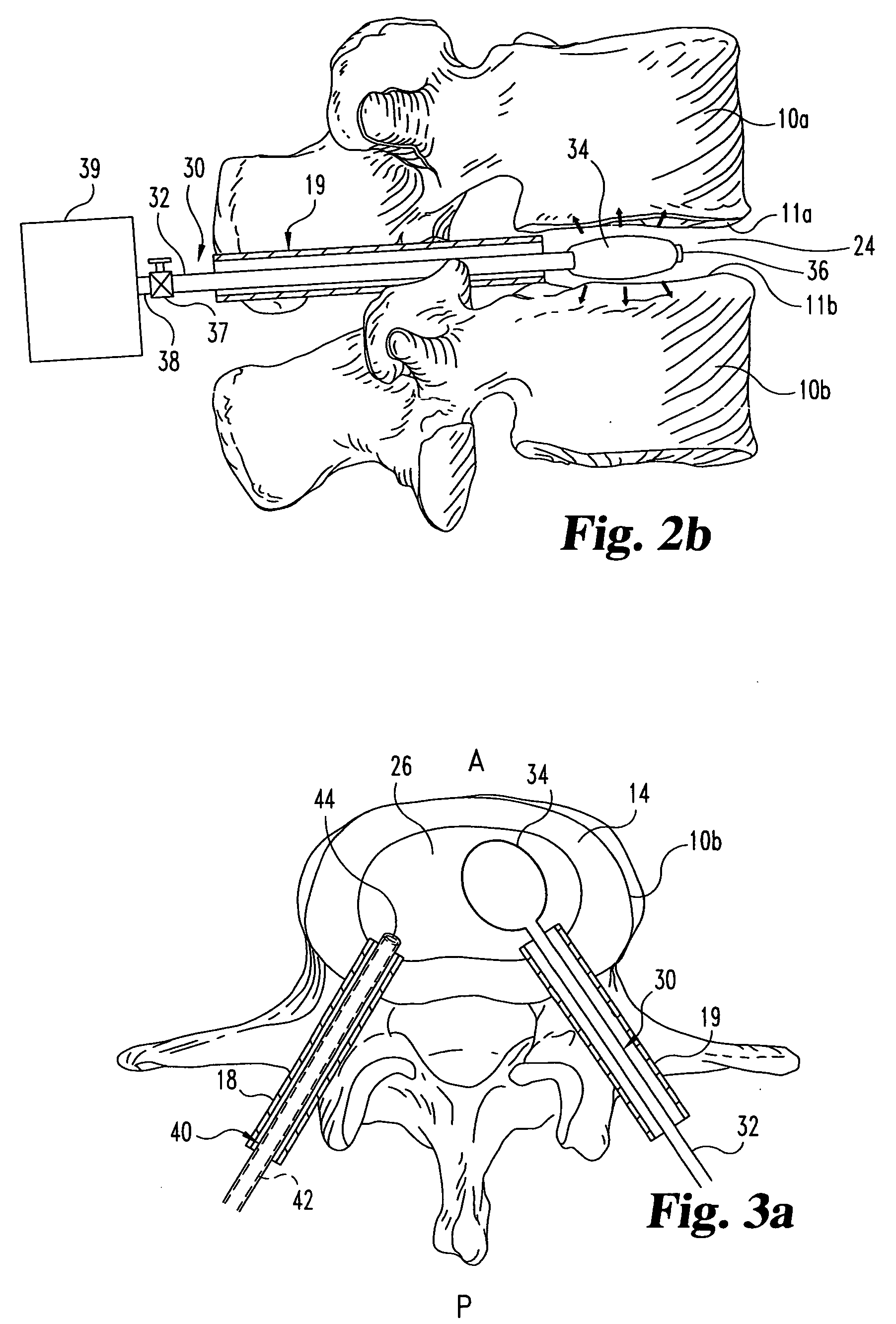 Methods and devices for interbody spinal stabilization