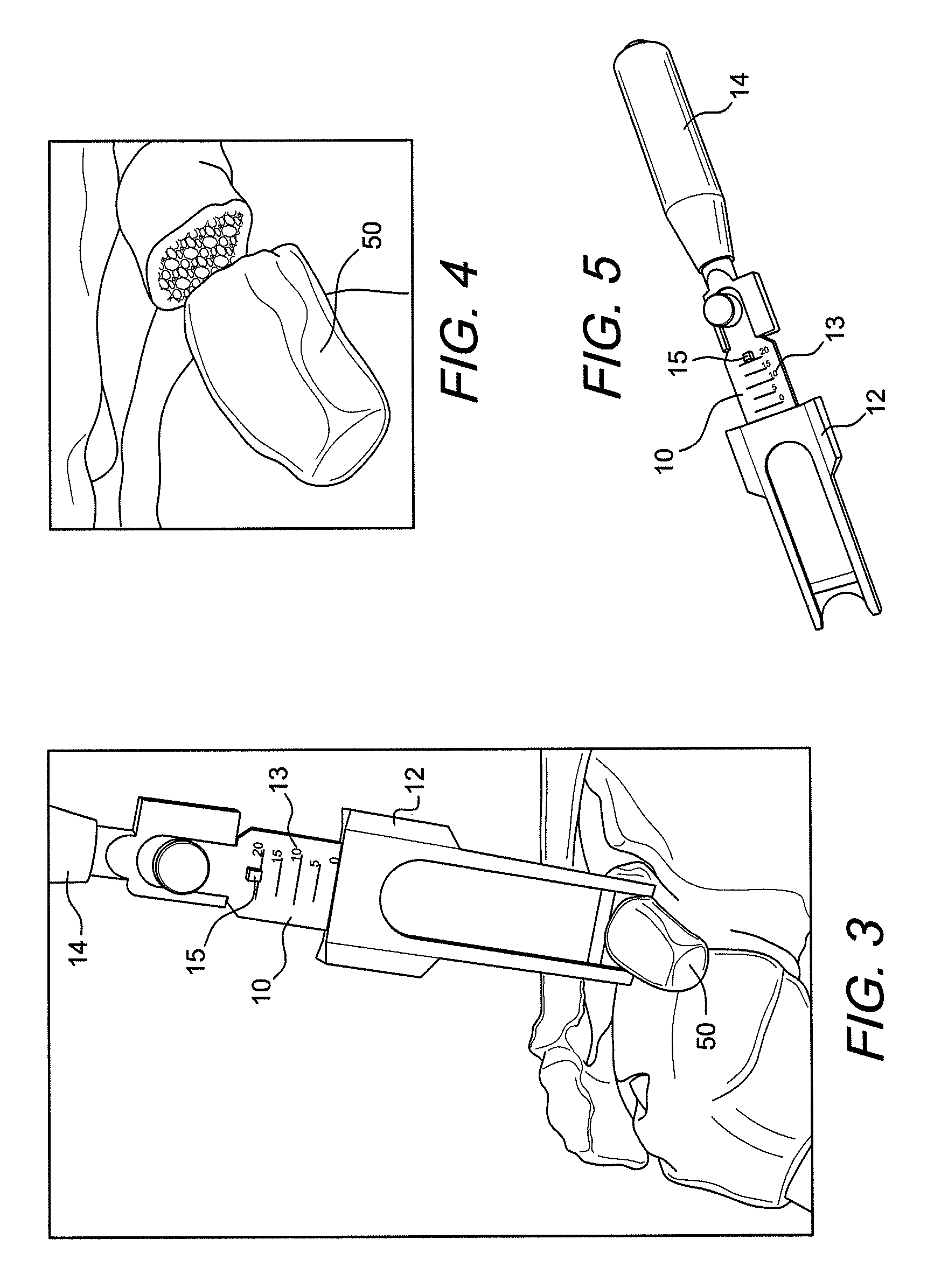 Latarjet instrumentation and method