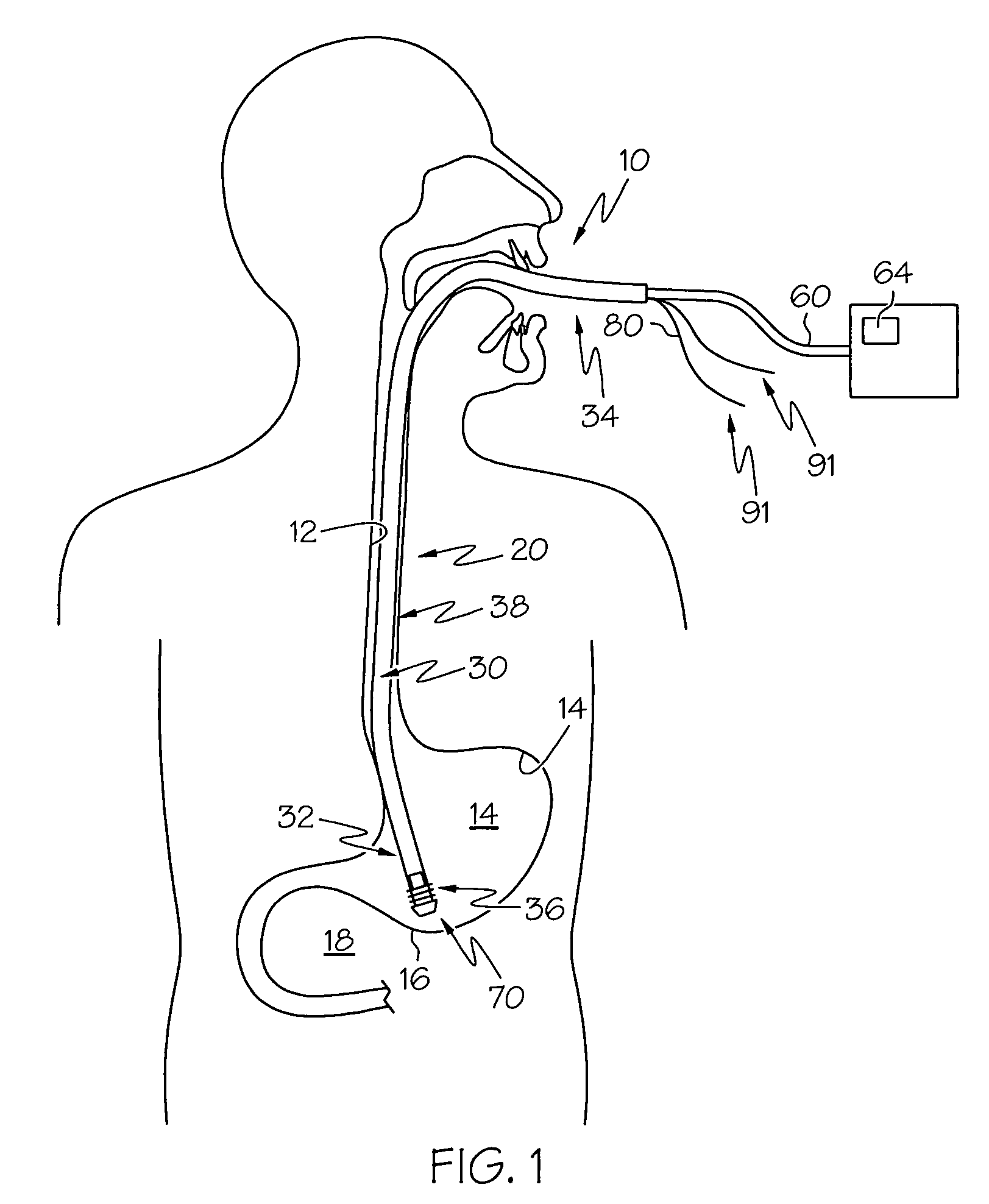 Detachable distal overtube section and methods for forming a sealable opening in the wall of an organ