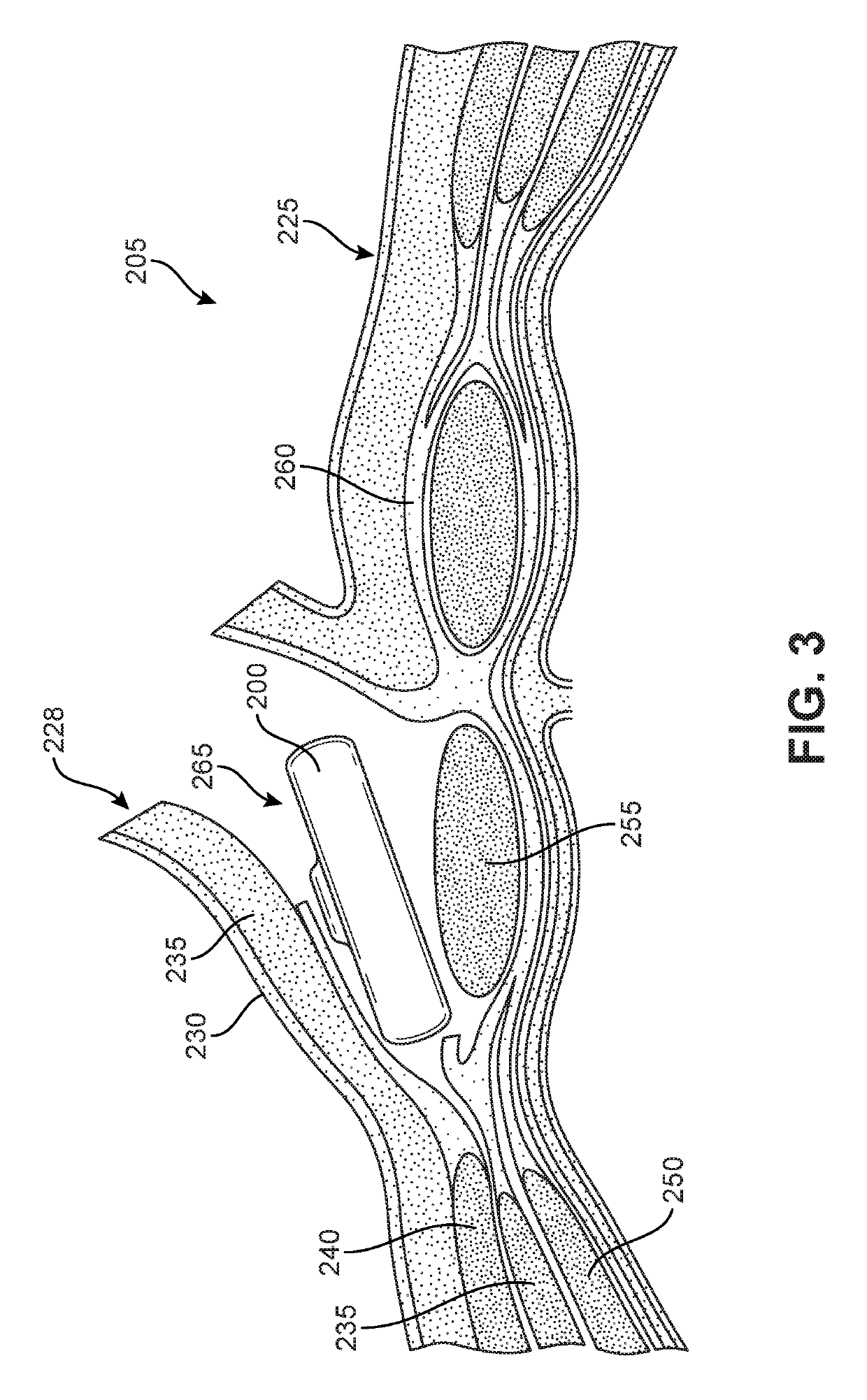 Pressure Bandage