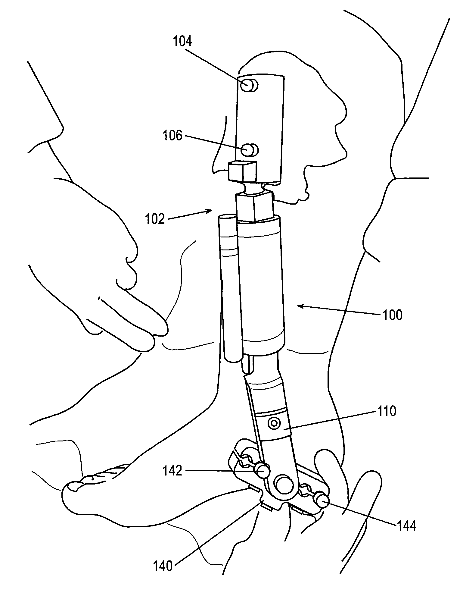 External fixation apparatus and method