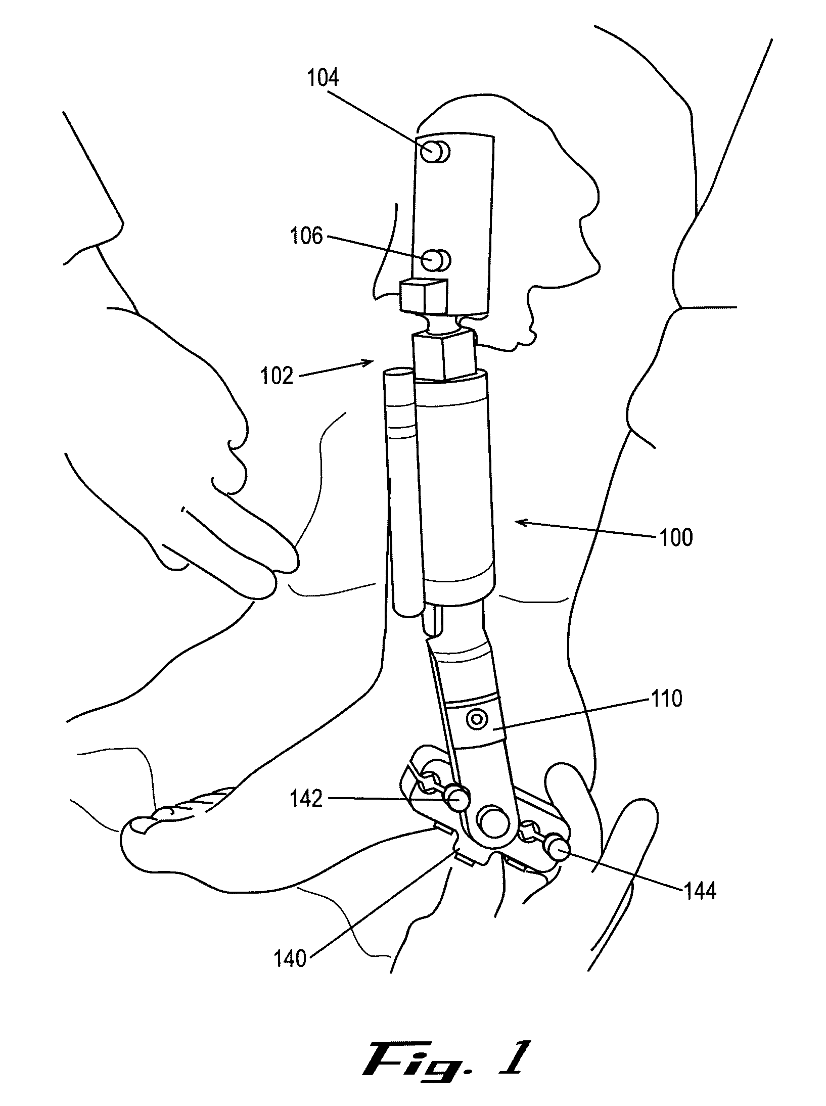 External fixation apparatus and method