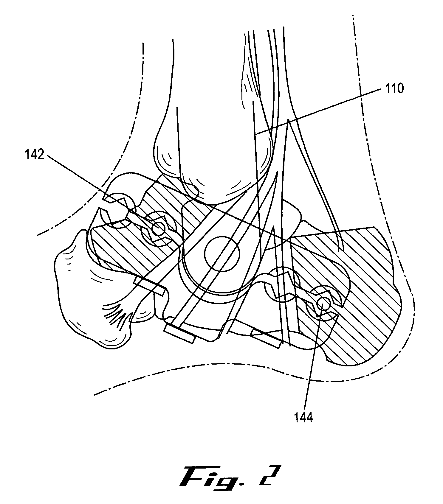 External fixation apparatus and method