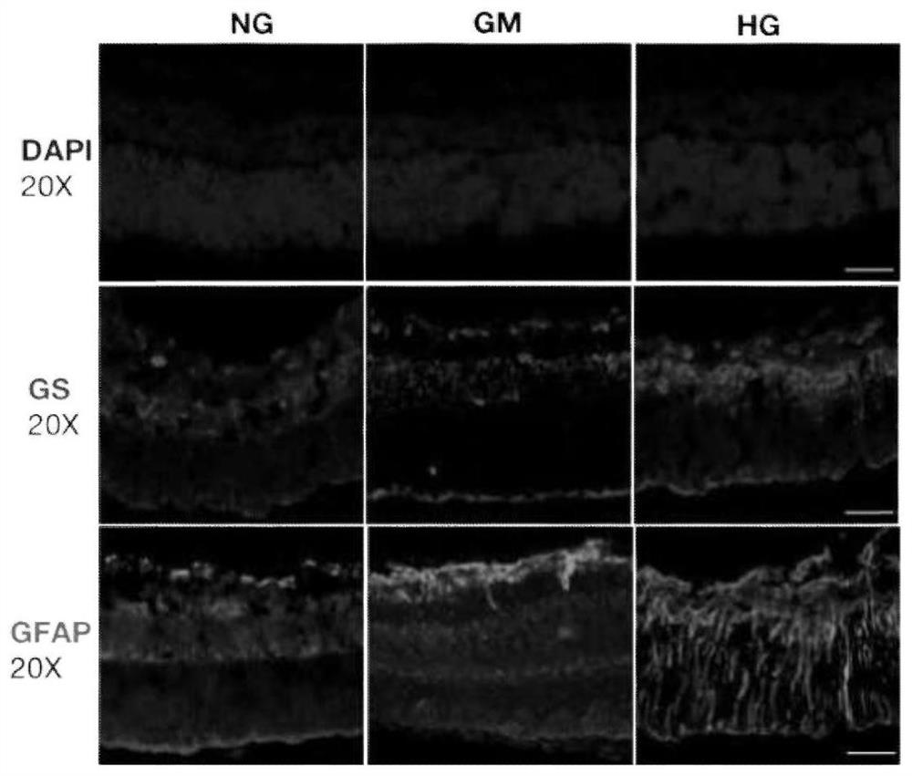 Method for constructing full-retina in-vitro culture model suffering from diabetes retinopathy