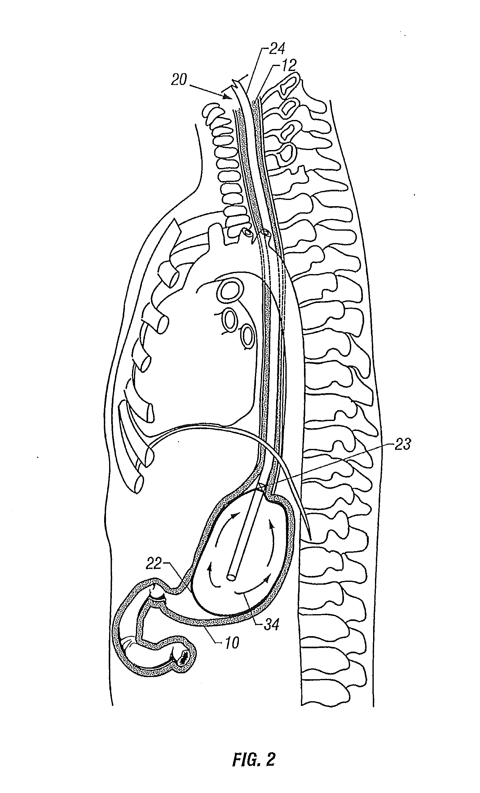 Apparatus and Method Of Gastric Cooling Using Balloon Catheter