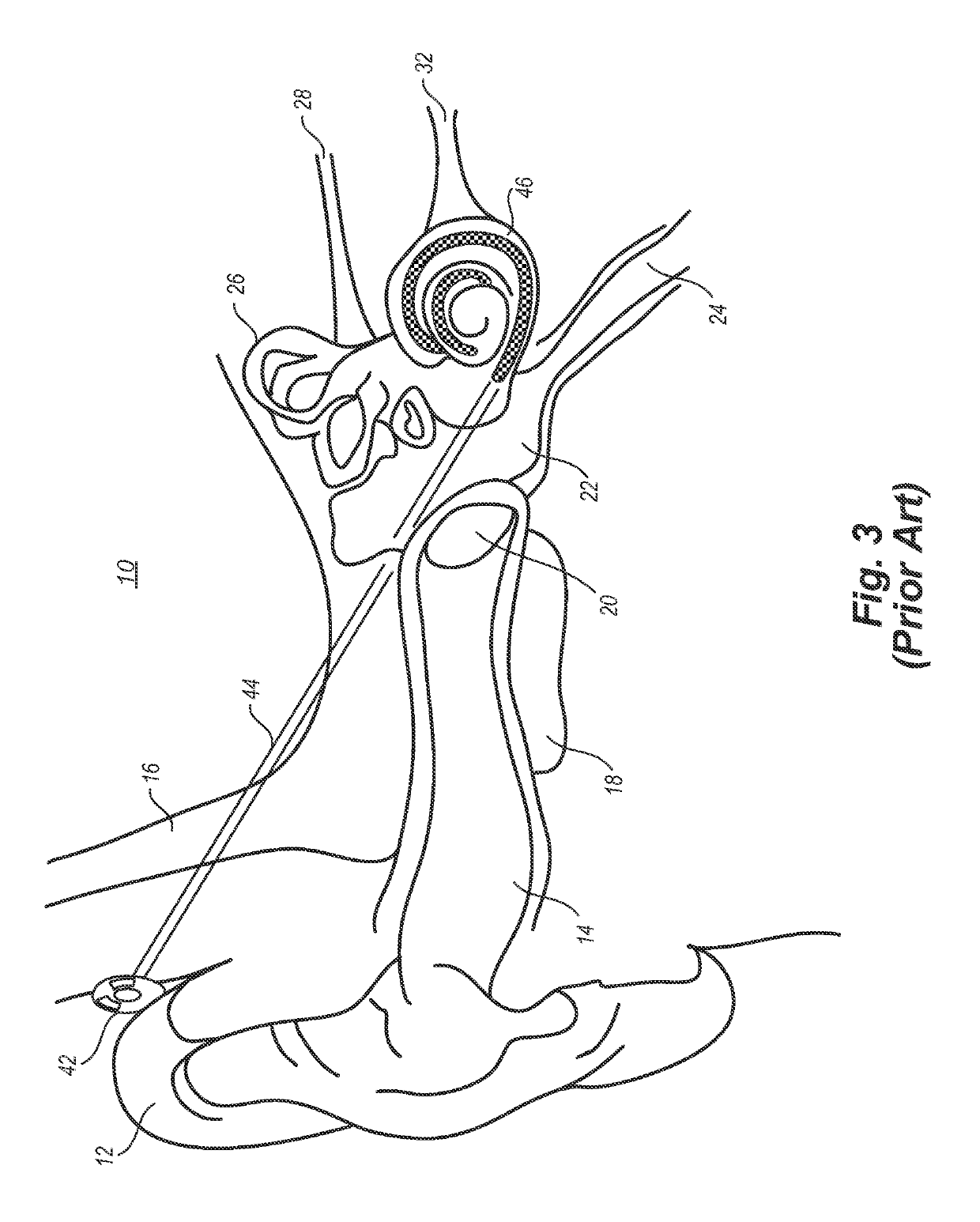 Localized therapeutic hypothermia system, device, and method