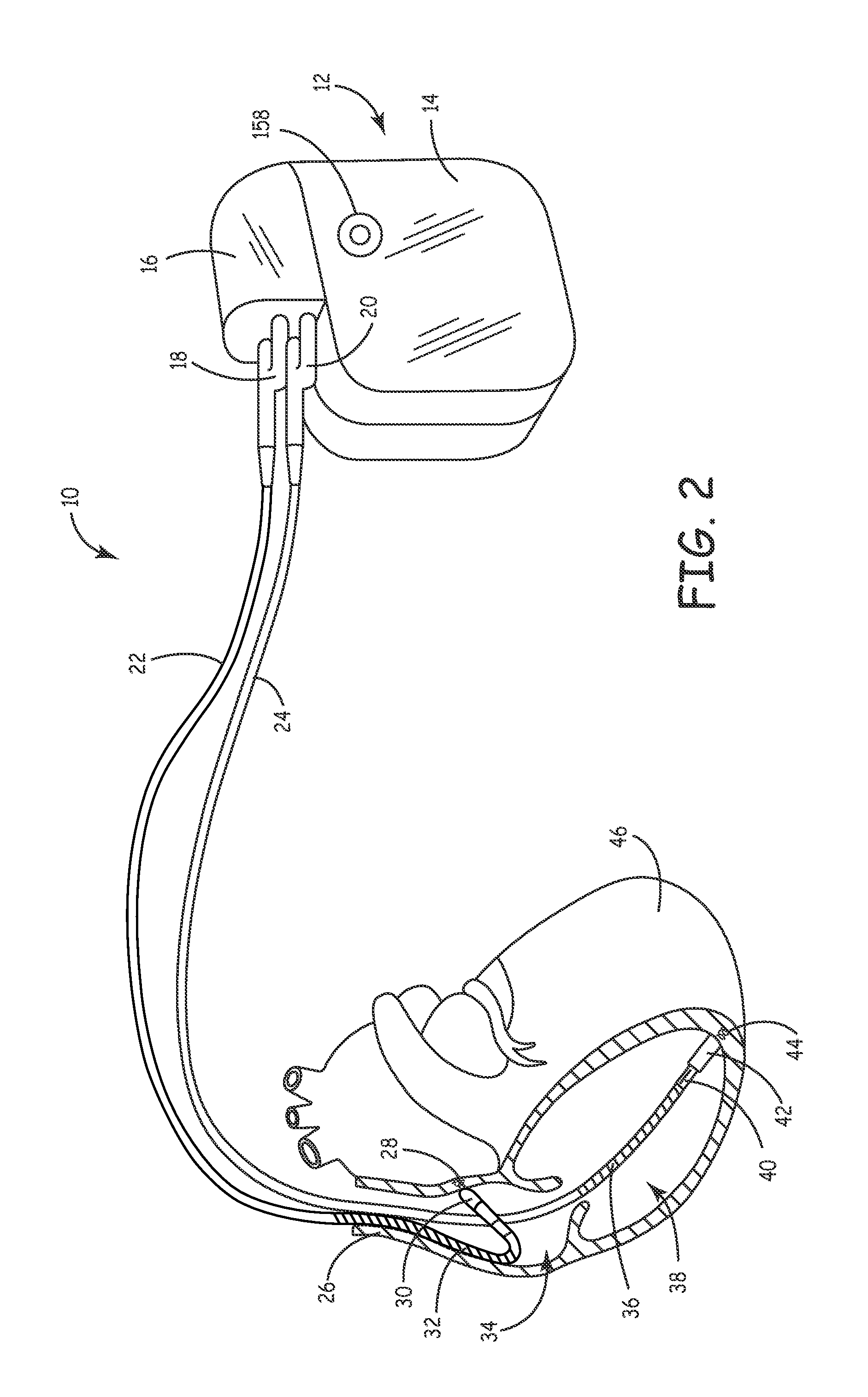 Method and apparatus for impedance signal localizations from implanted devices