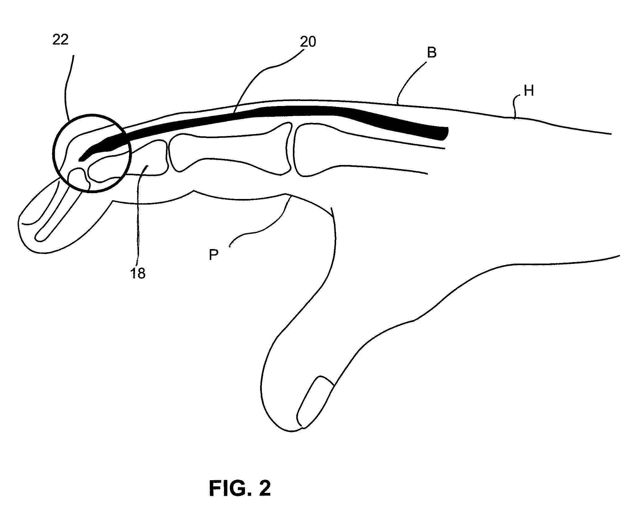 Goalkeeper's glove with protective fingertip extension