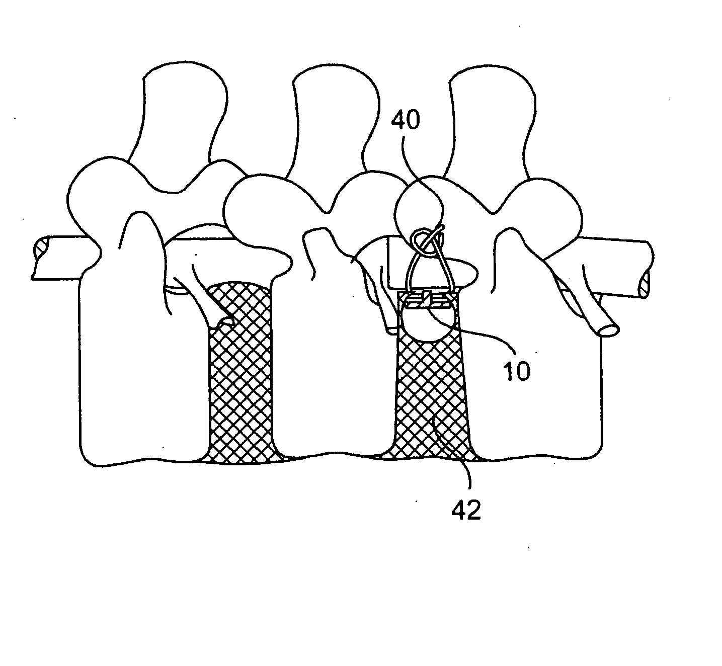 Spinal disc annulus reconstruction method and deformable spinal disc annulus stent