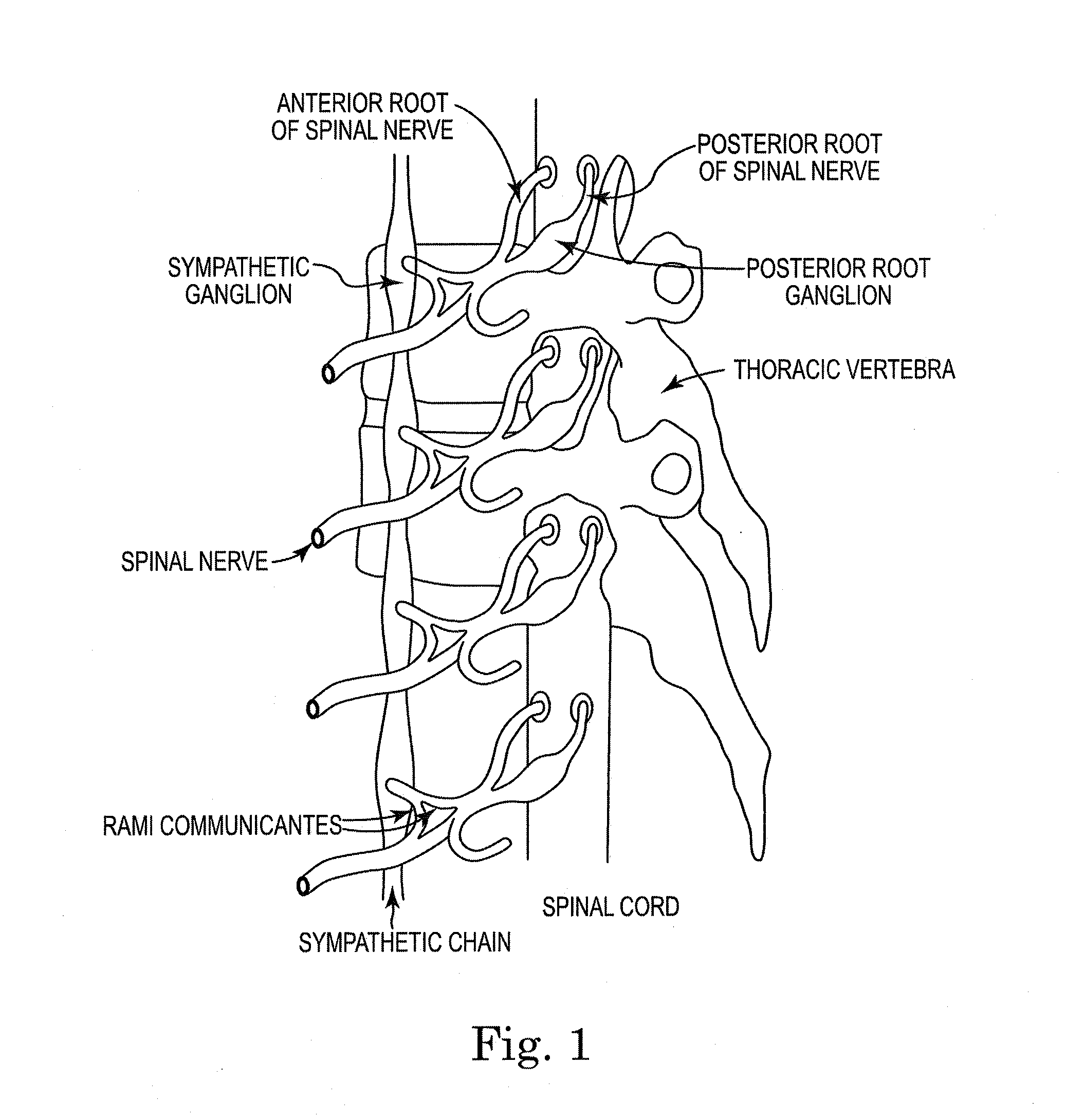 Non-invasive or minimally invasive paraspinal sympathetic ablation for the treatment of resistant hypertension