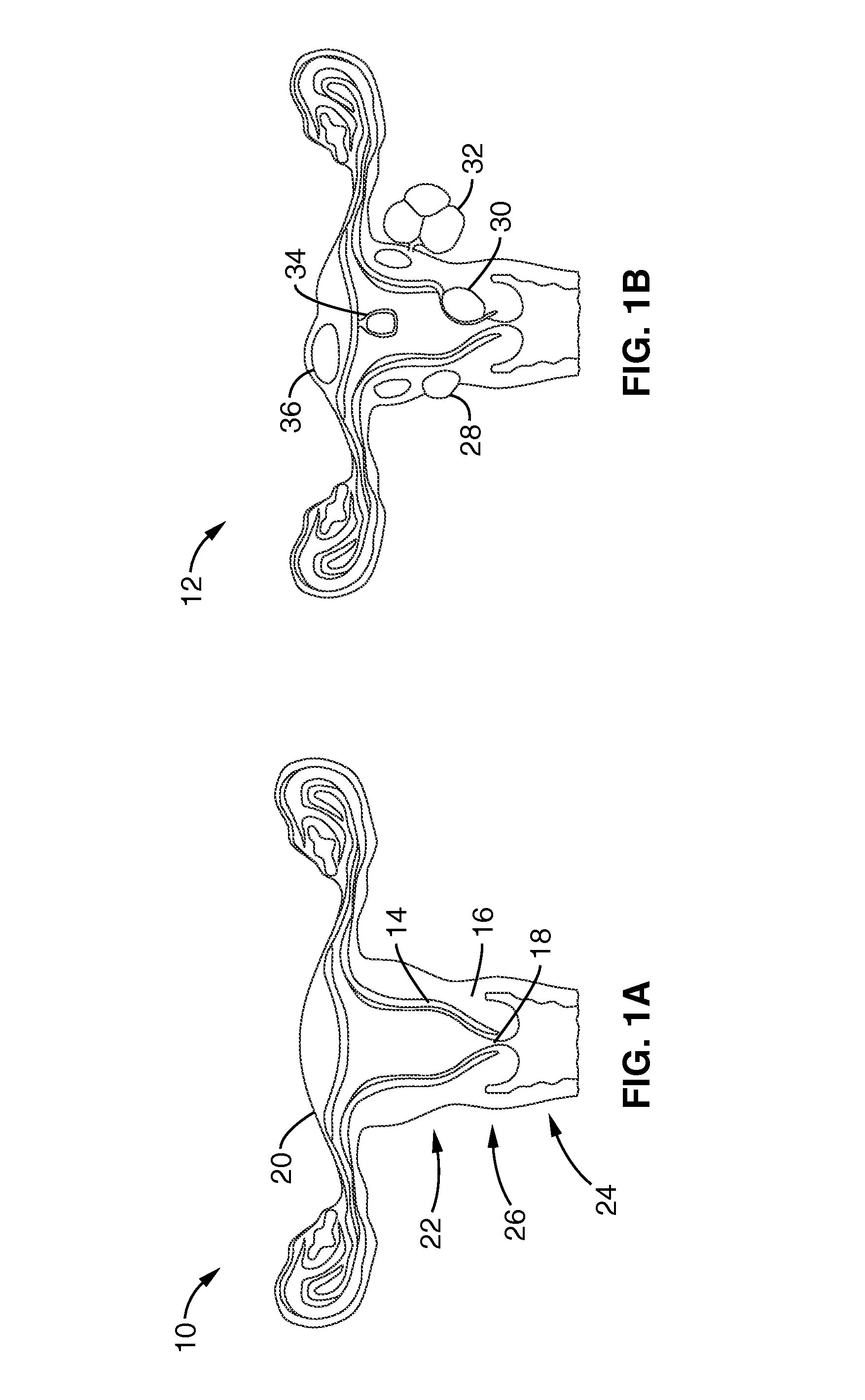 Method of thermal treatment of myolysis and destruction of benign uterine tumors