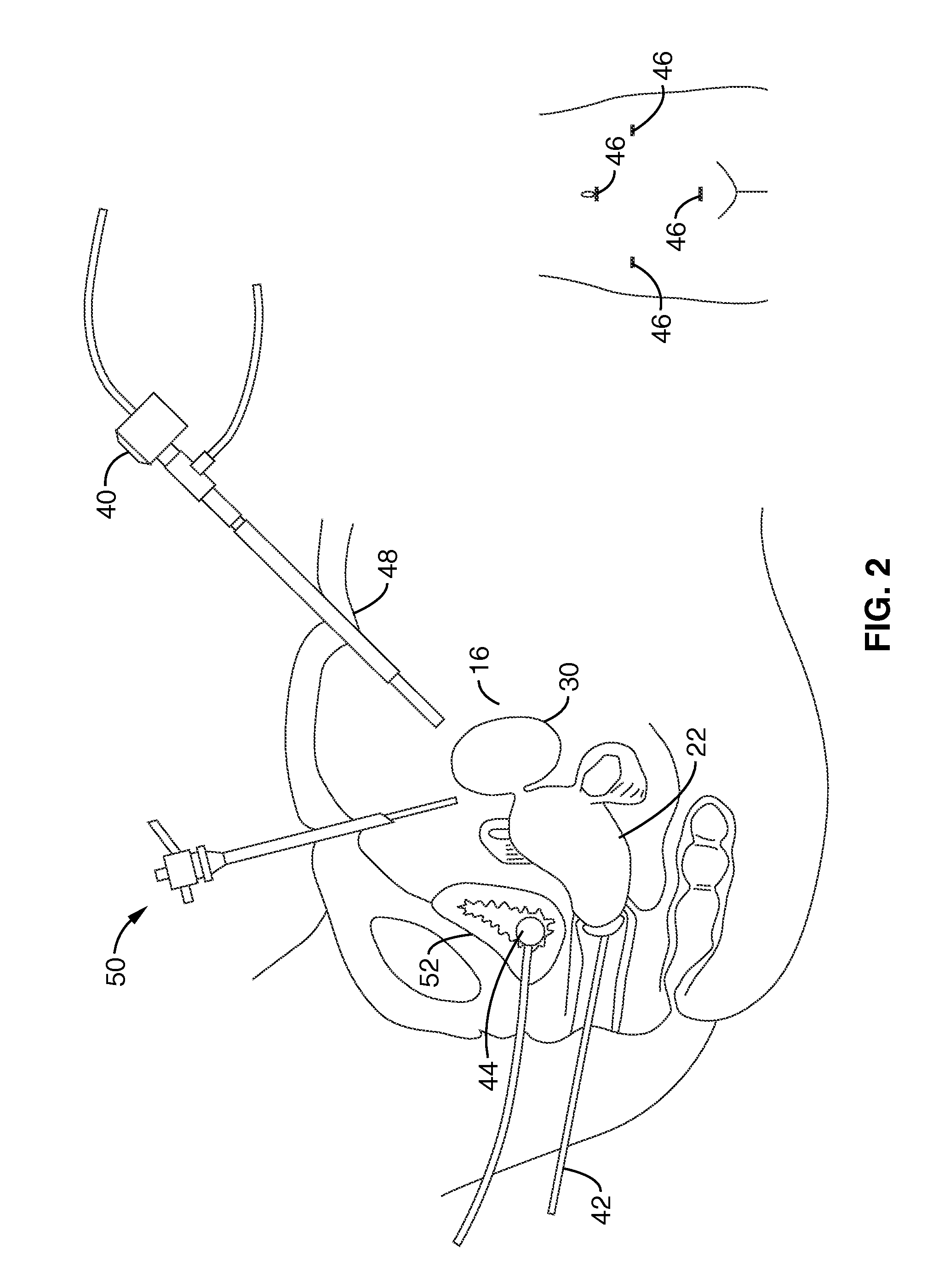 Method of thermal treatment of myolysis and destruction of benign uterine tumors