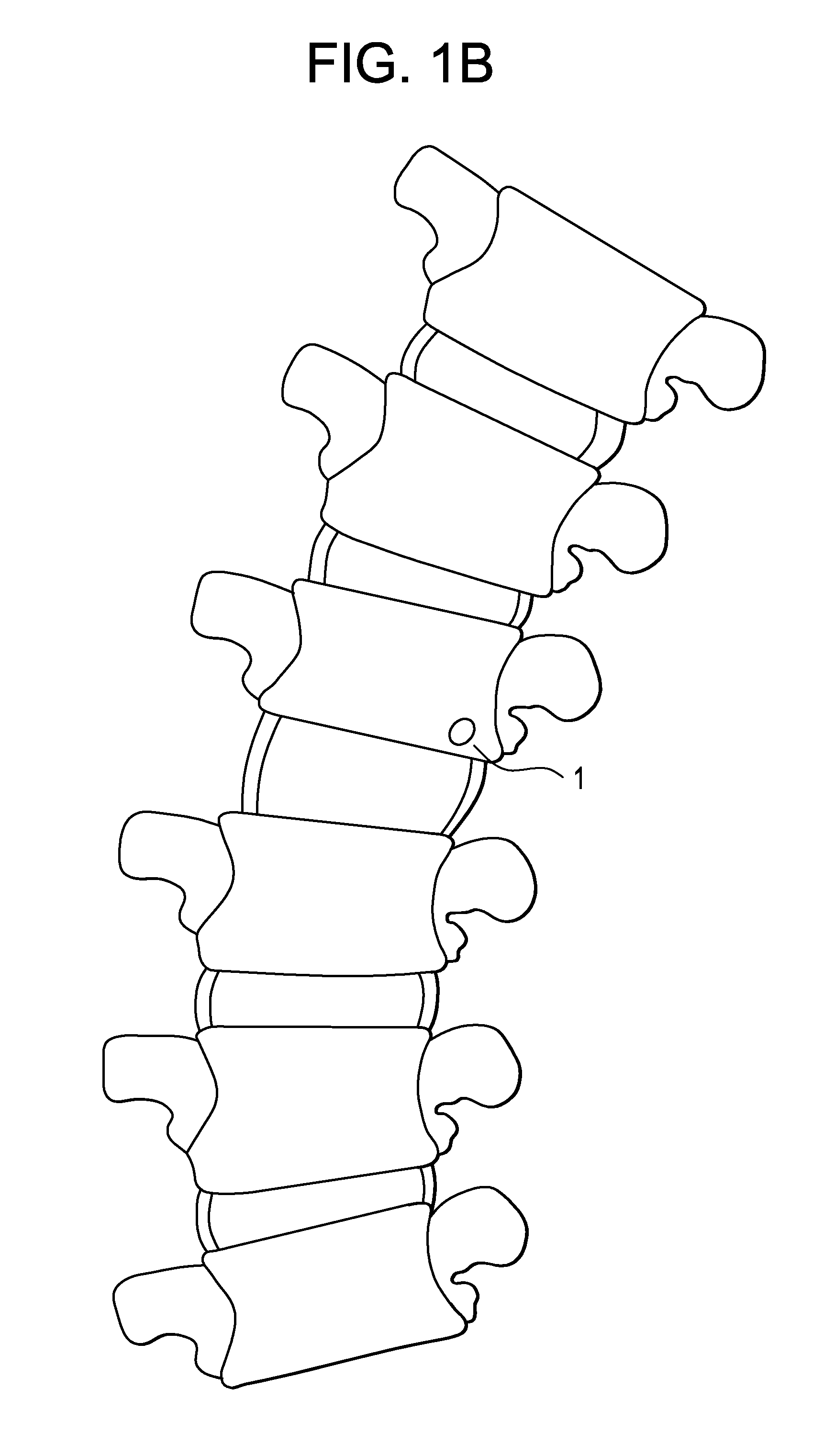 Methods and devices for correcting spinal deformity with pharmaceutical-eluting pedicle screws