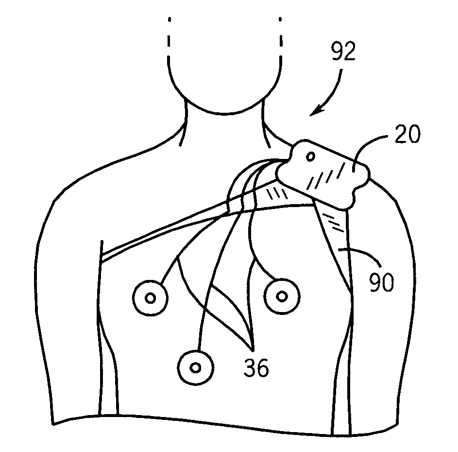 Wireless in-bore patient monitor for MRI