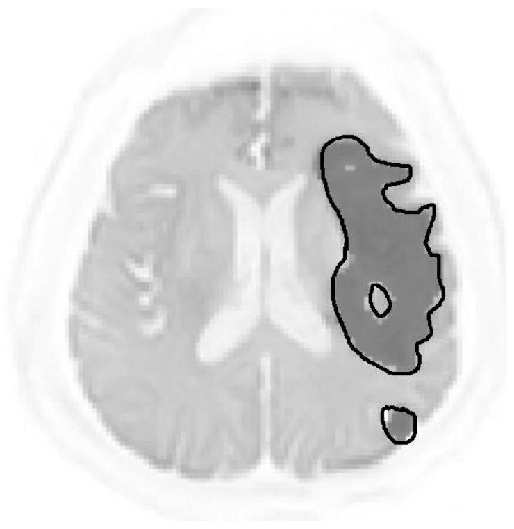 Cerebral apoplexy typing method and device based on vascular image completion