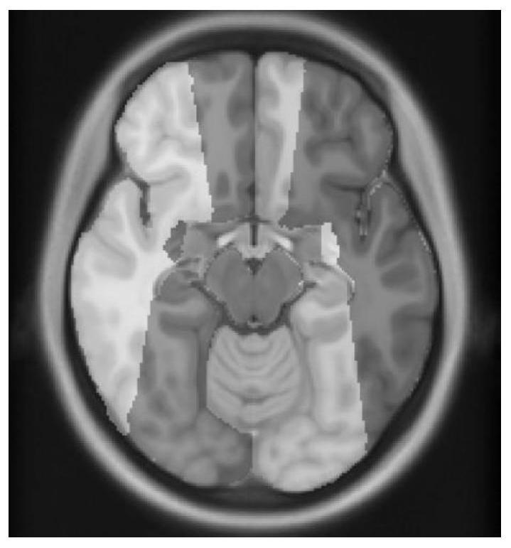 Cerebral apoplexy typing method and device based on vascular image completion