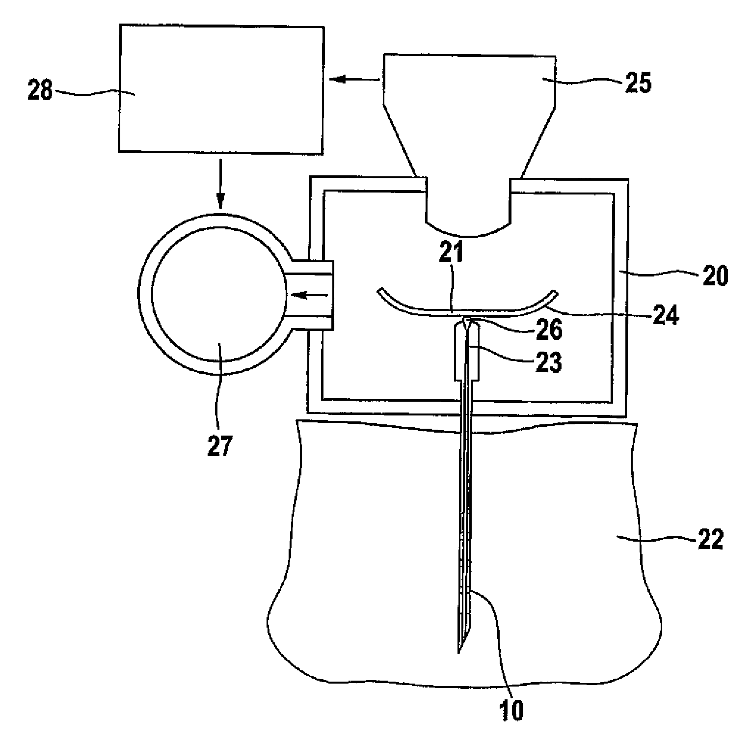 Catheter With Microchannels For Monitoring The Concentration Of An Analyte In A Bodily Fluid