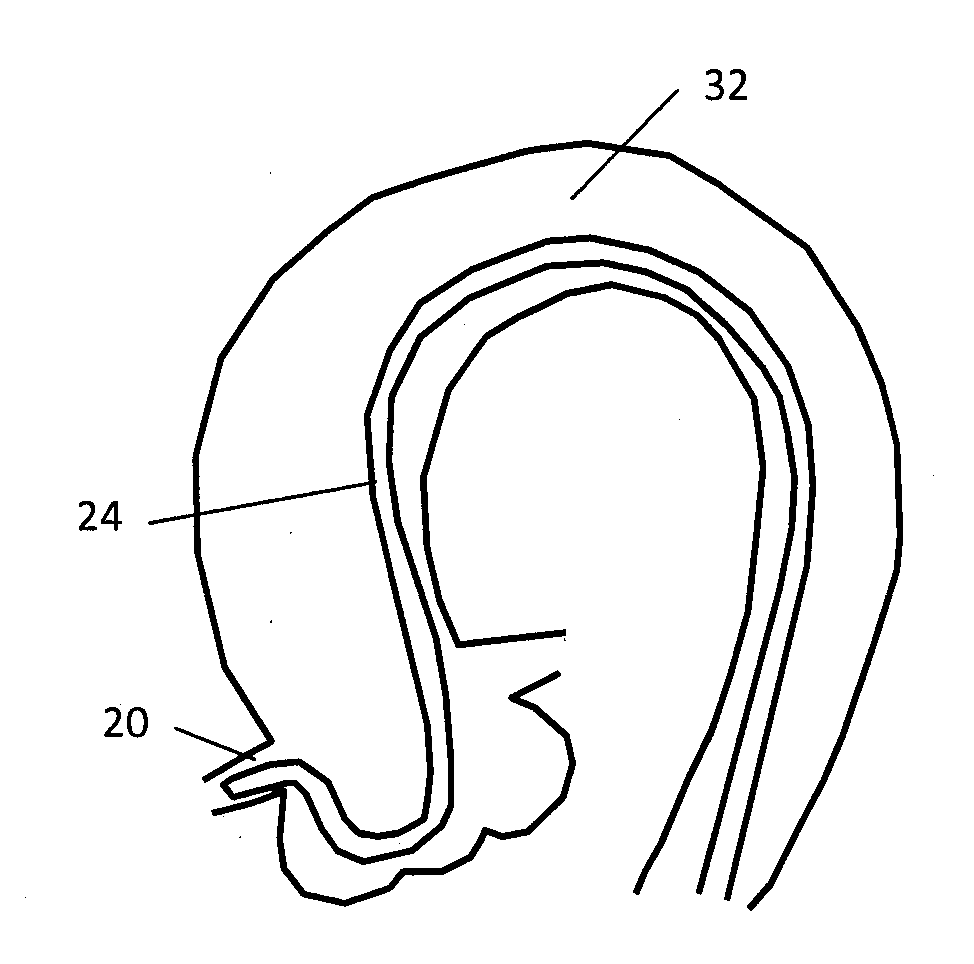 Stent and stent delivery system with improved deliverability