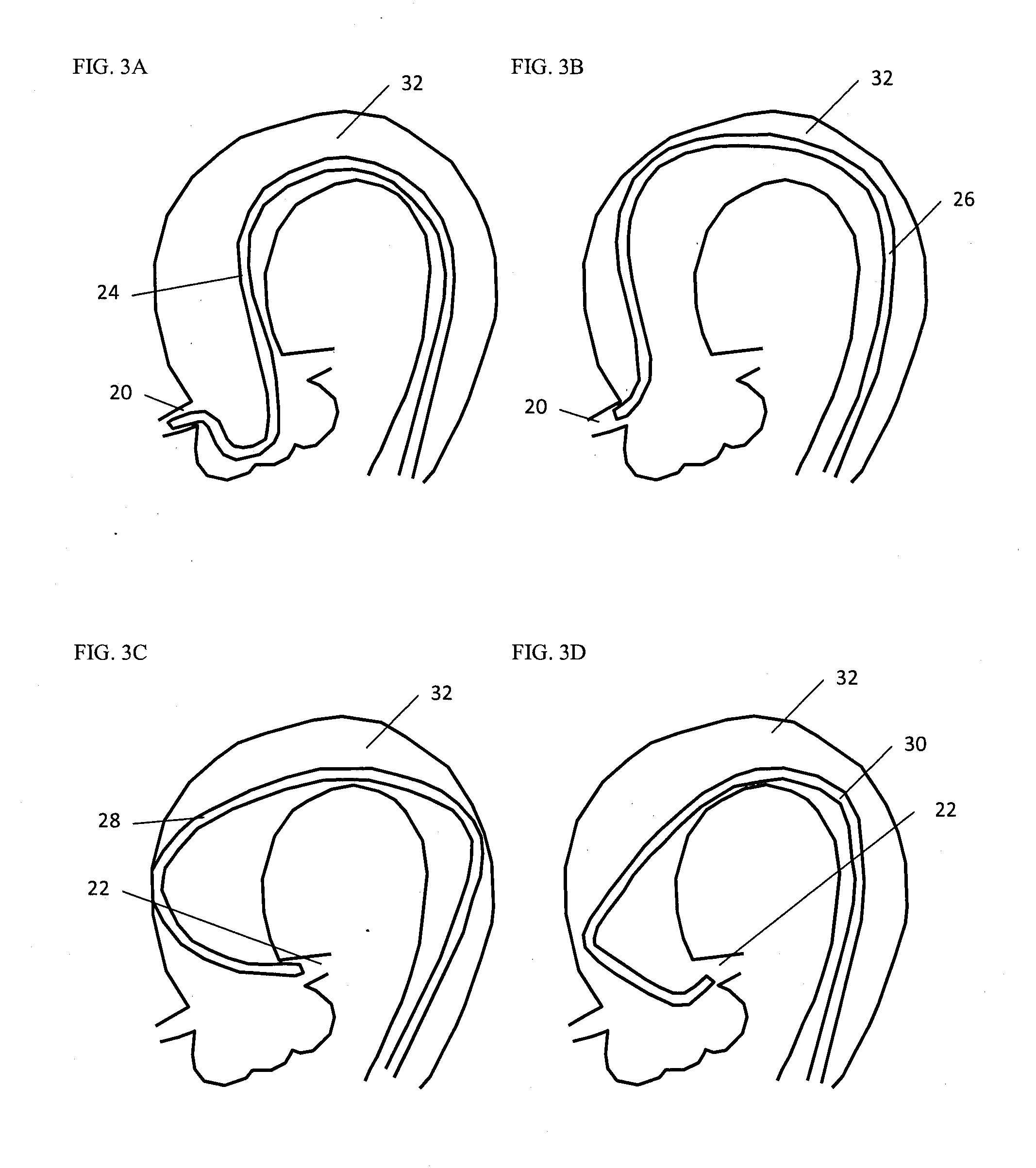 Stent and stent delivery system with improved deliverability