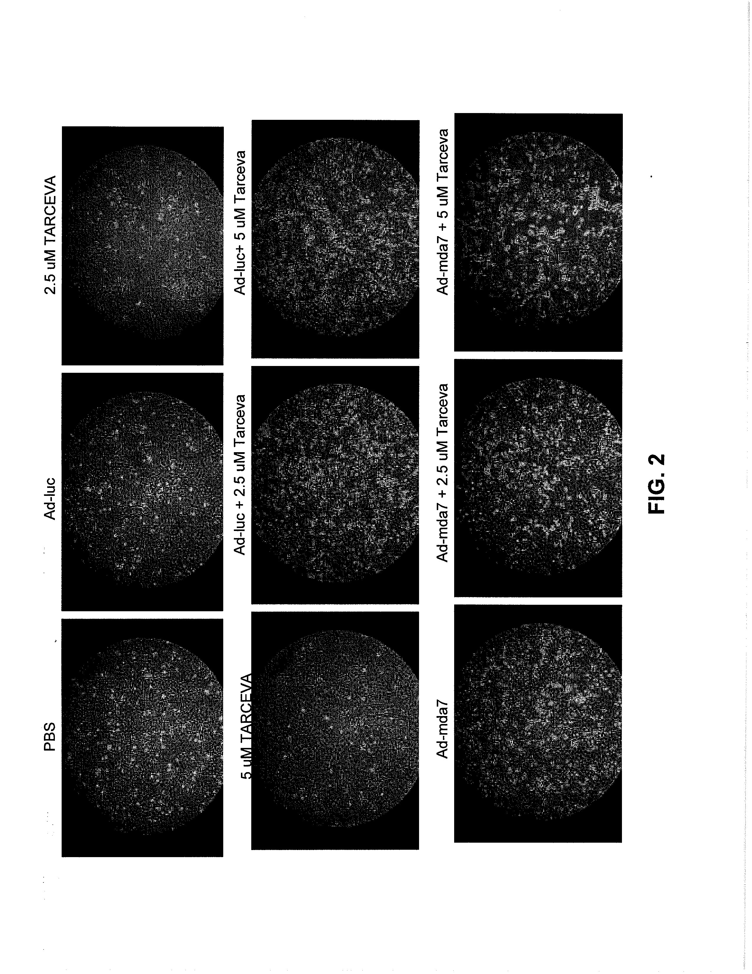 Compositions and Methods Involving MDA-7 for the Treatment of Cancer