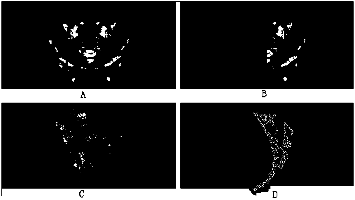 Sacroiliac screw digitalized imbedding method based on 3D printing