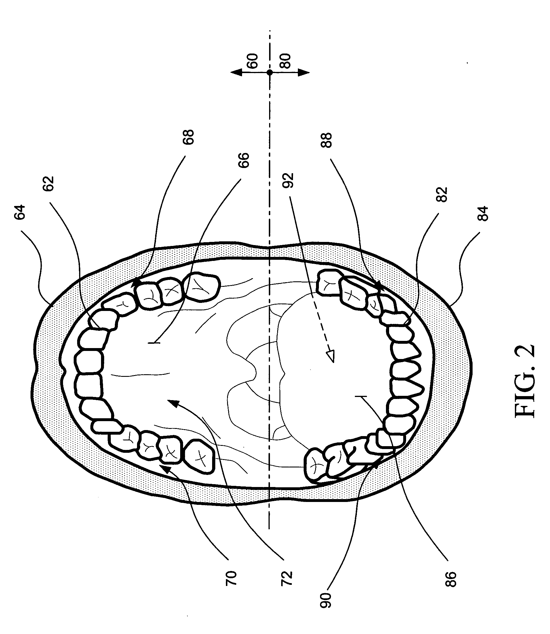 Intraoral aversion devices and methods