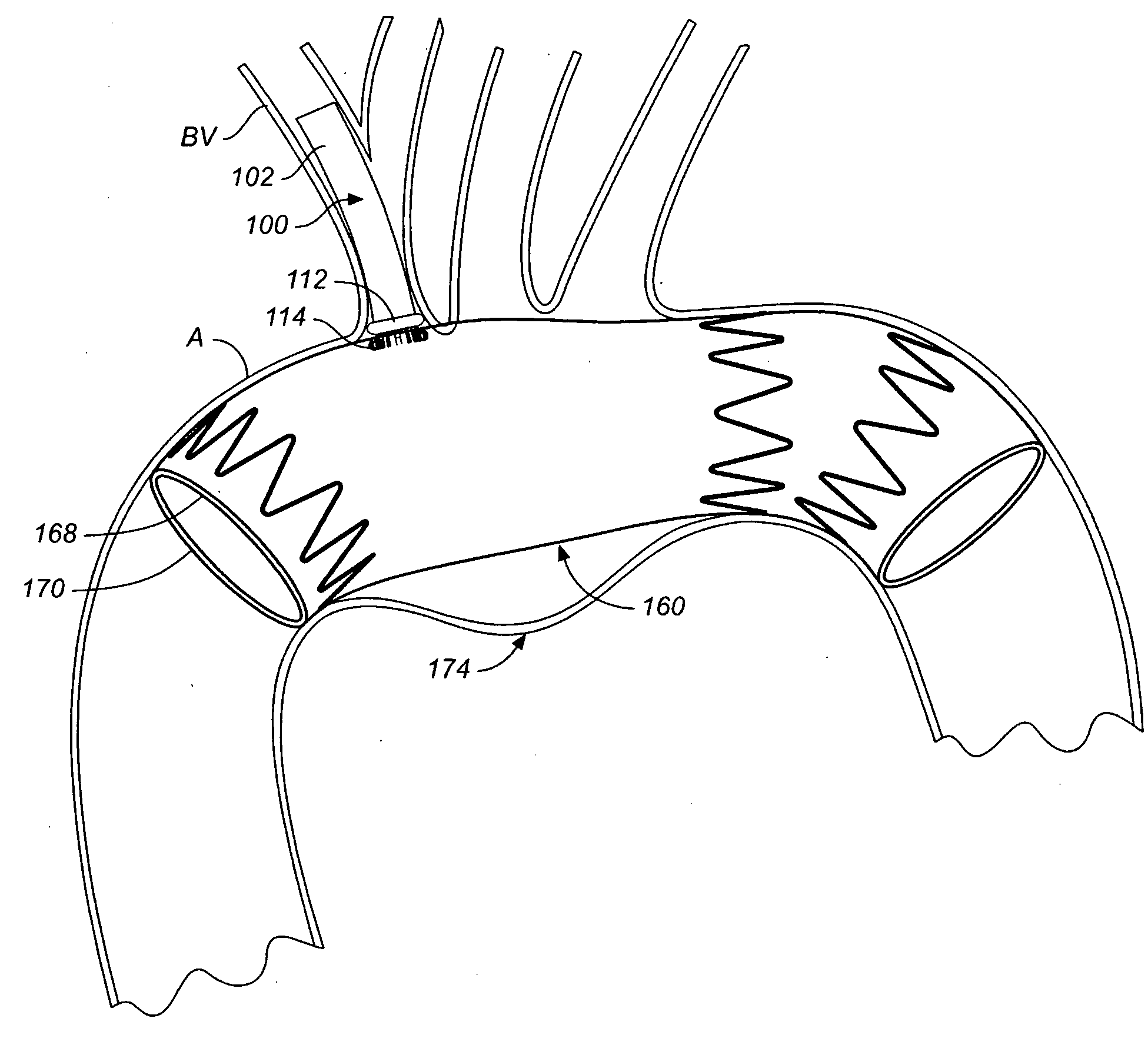 Branch Vessel Prosthesis With a Roll-Up Sealing Assembly