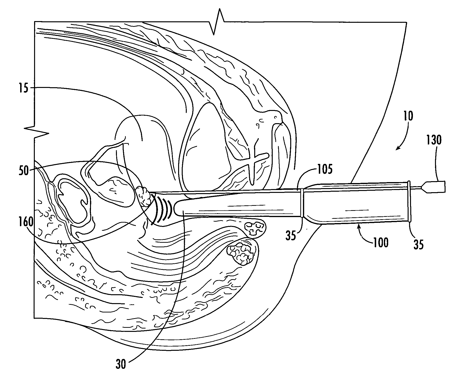 Echogenic needle for transvaginal ultrasound directed reduction of uterine fibroids and an associated method