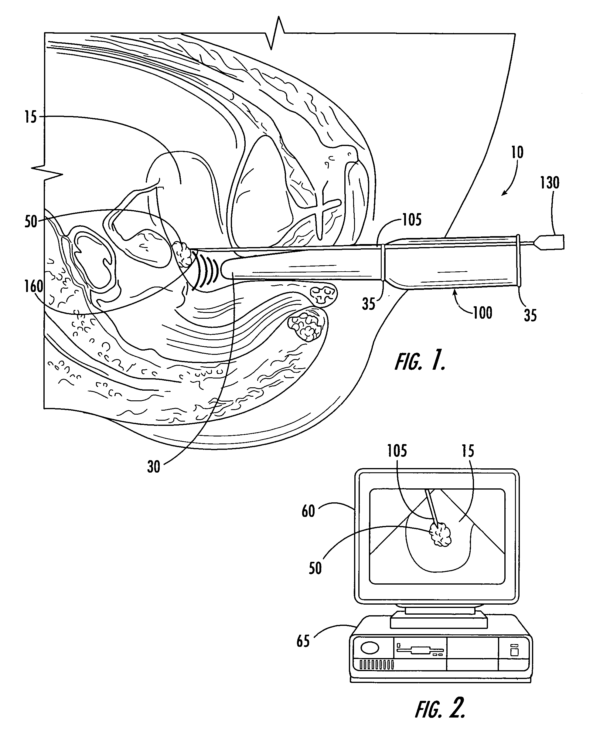 Echogenic needle for transvaginal ultrasound directed reduction of uterine fibroids and an associated method