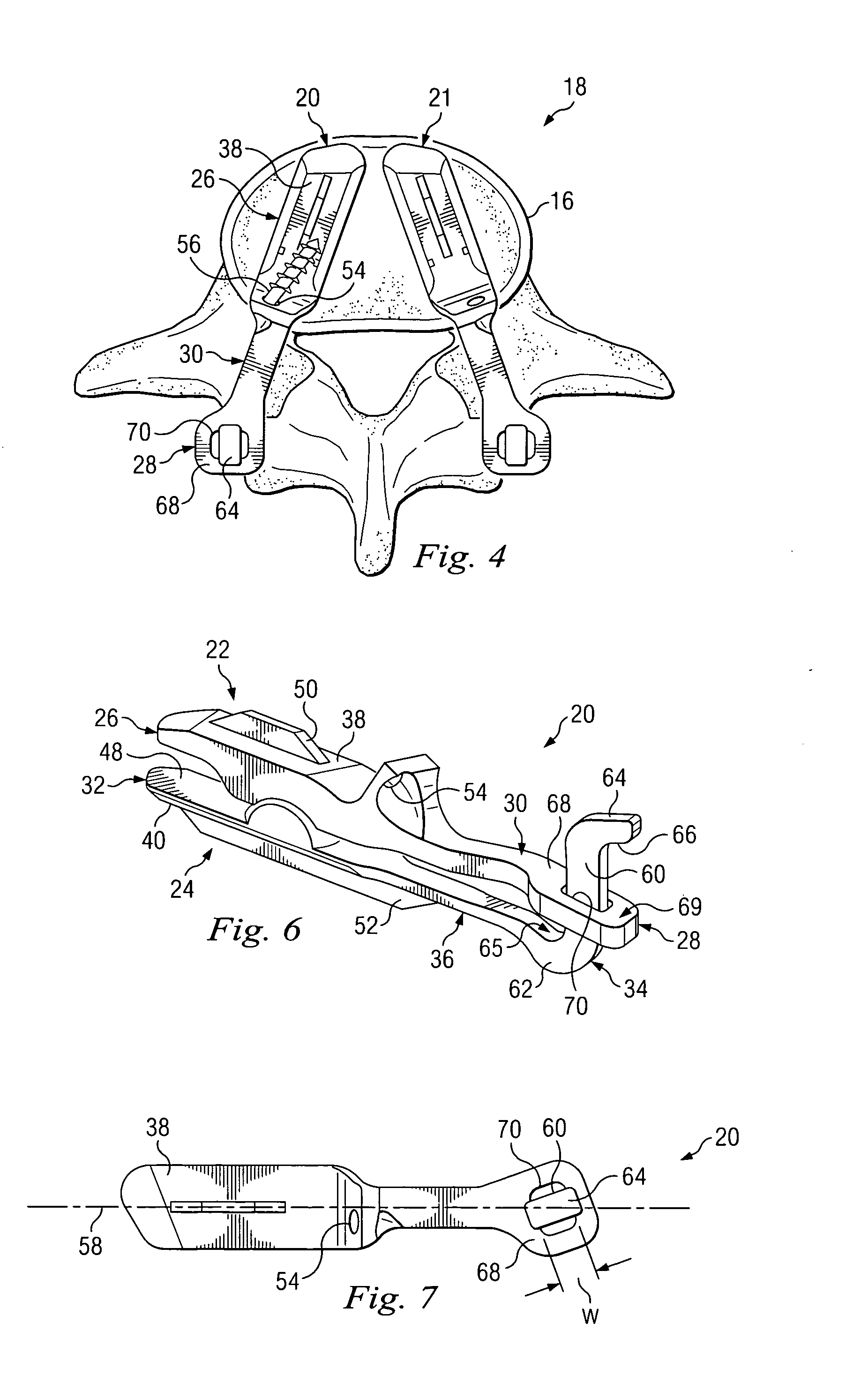 Posterior joint replacement device