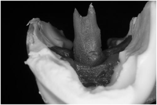 Gypsum-free novel digital post-core impression collection and model building technology