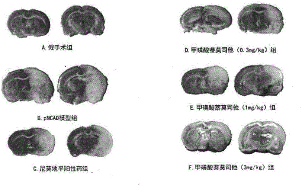 Application of nafamostat mesilate in preparing drugs for preventing and curing ischemic cerebral apoplexy