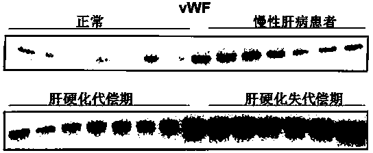 Biomarkers von willebrand factor (VWF) and ADAMTS13 and use thereof in cirrhosis diagnosis reagent