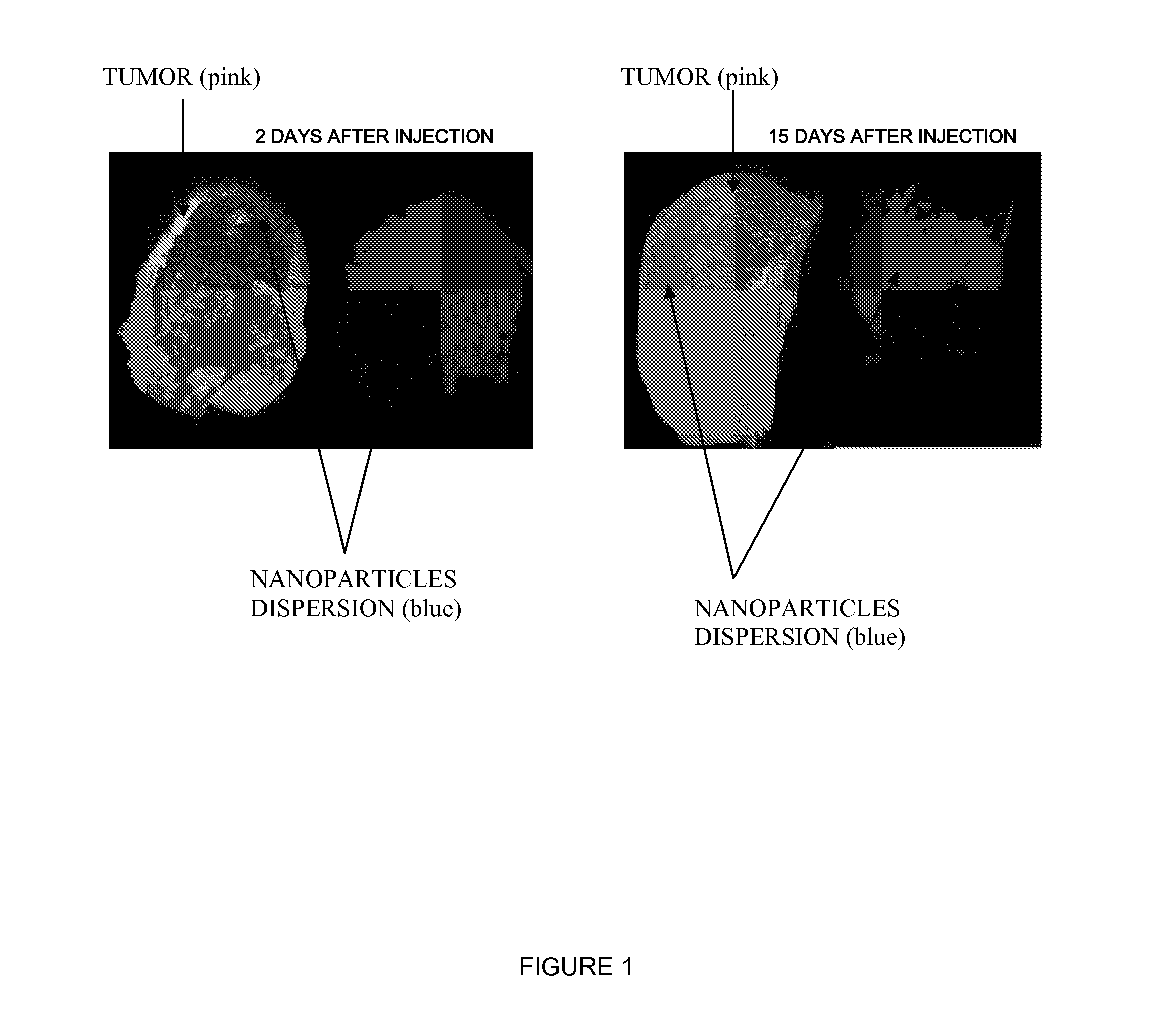 Inorganic Nanoparticles of High Density to Destroy Cells In-Vivo