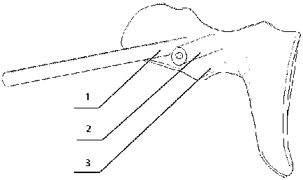 Individualized lumbar pedicle screw placement guiding device