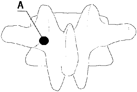 Individualized lumbar pedicle screw placement guiding device