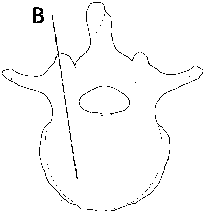 Individualized lumbar pedicle screw placement guiding device