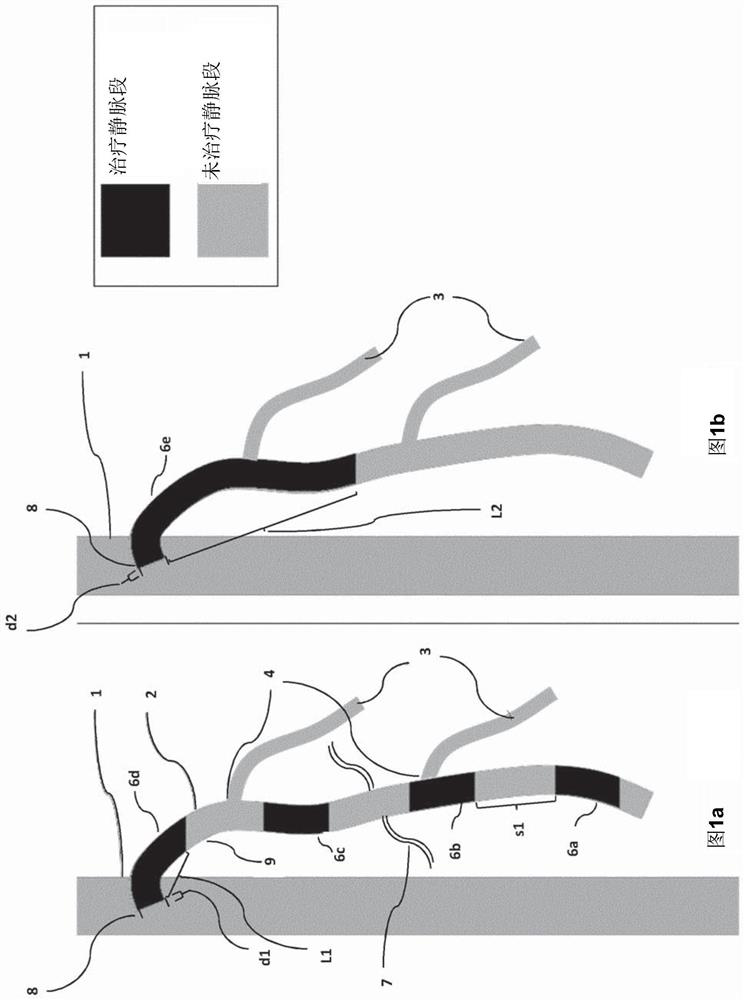 Method and device for treating varicose veins by application of high-intensity focused ultrasound