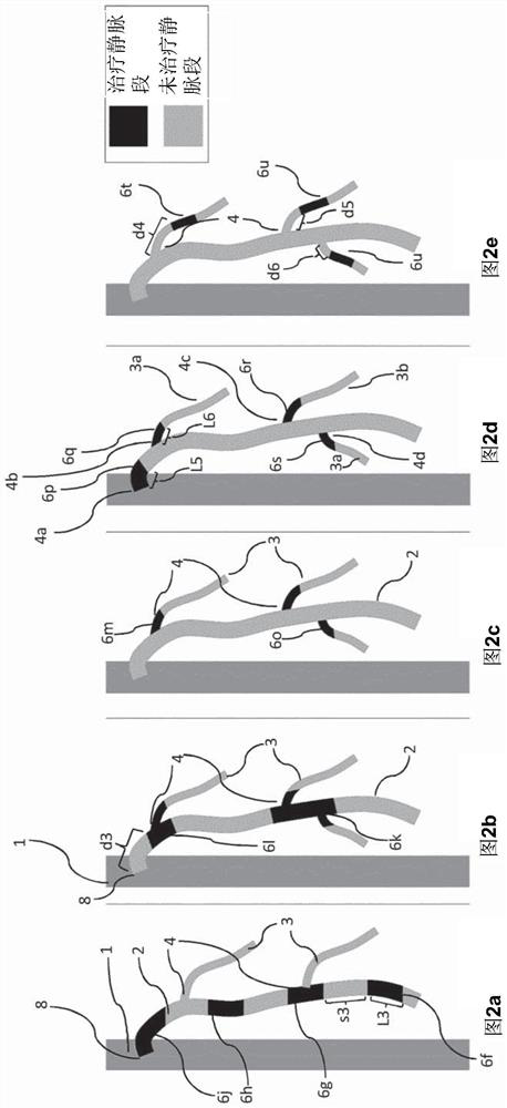 Method and device for treating varicose veins by application of high-intensity focused ultrasound