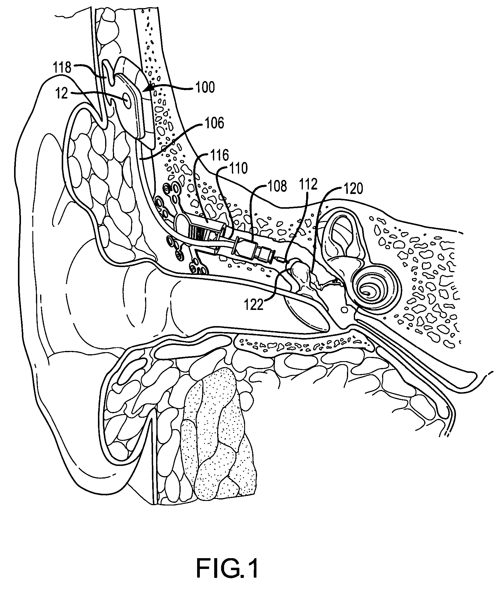 Active vibration attenuation for implantable microphone