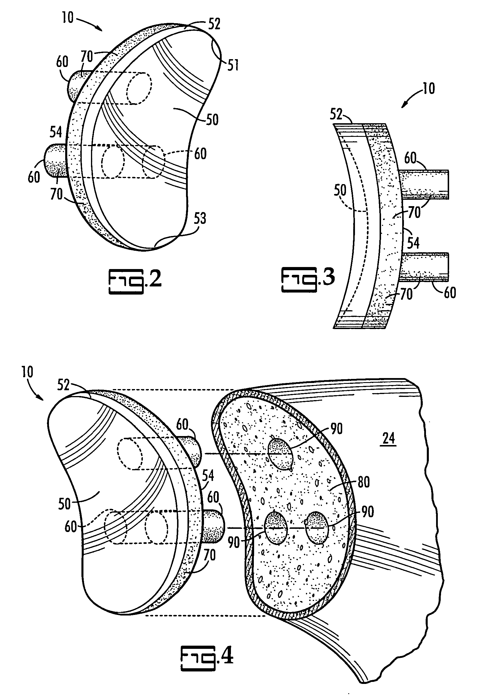 Hydroxyapatite backed glenoid prosthesis