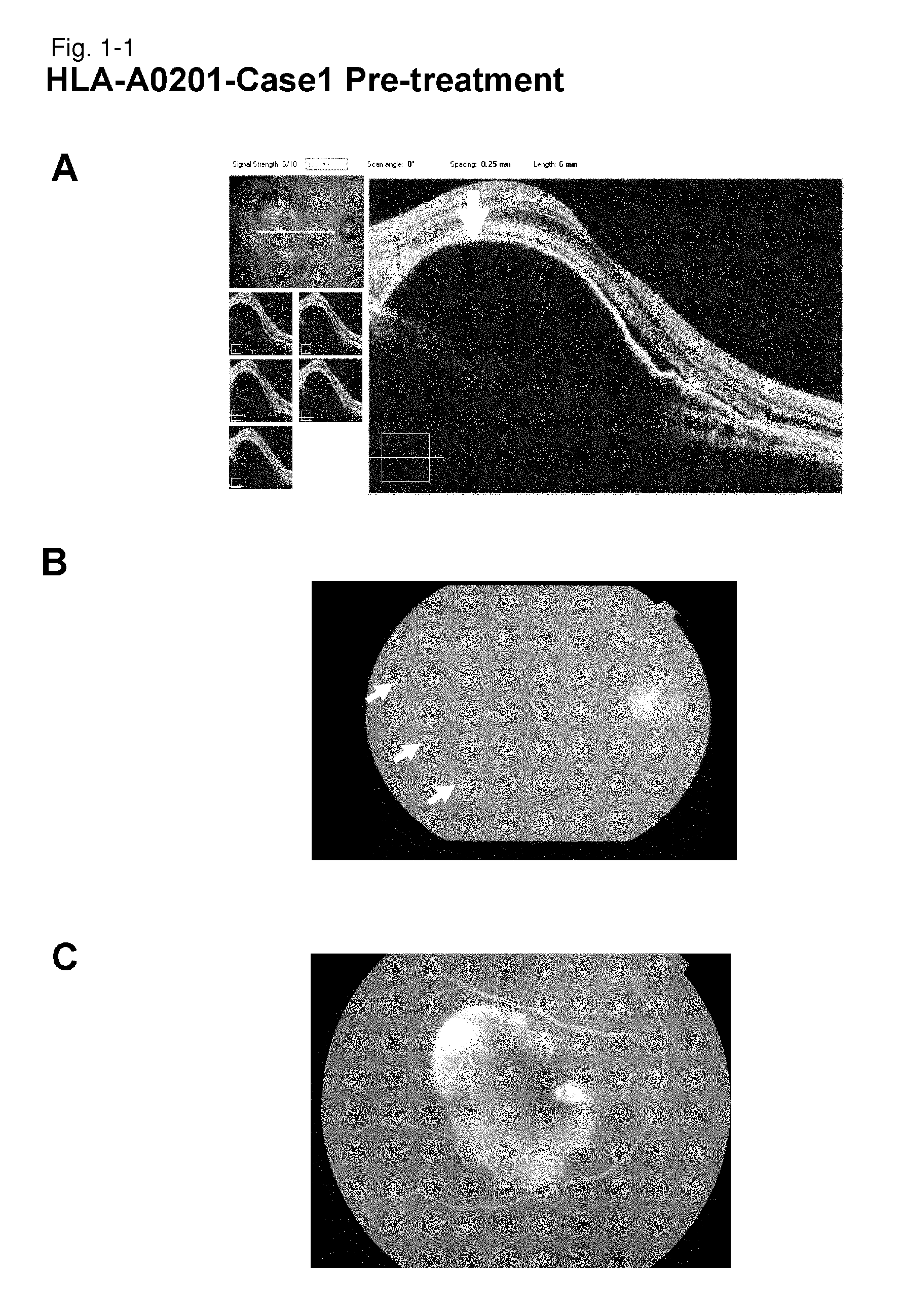 Methods for treating a disease caused by choroidal neovascularization