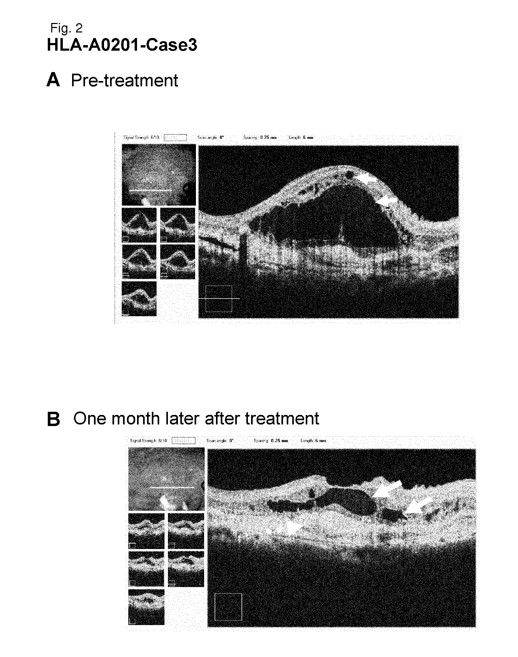 Methods for treating a disease caused by choroidal neovascularization